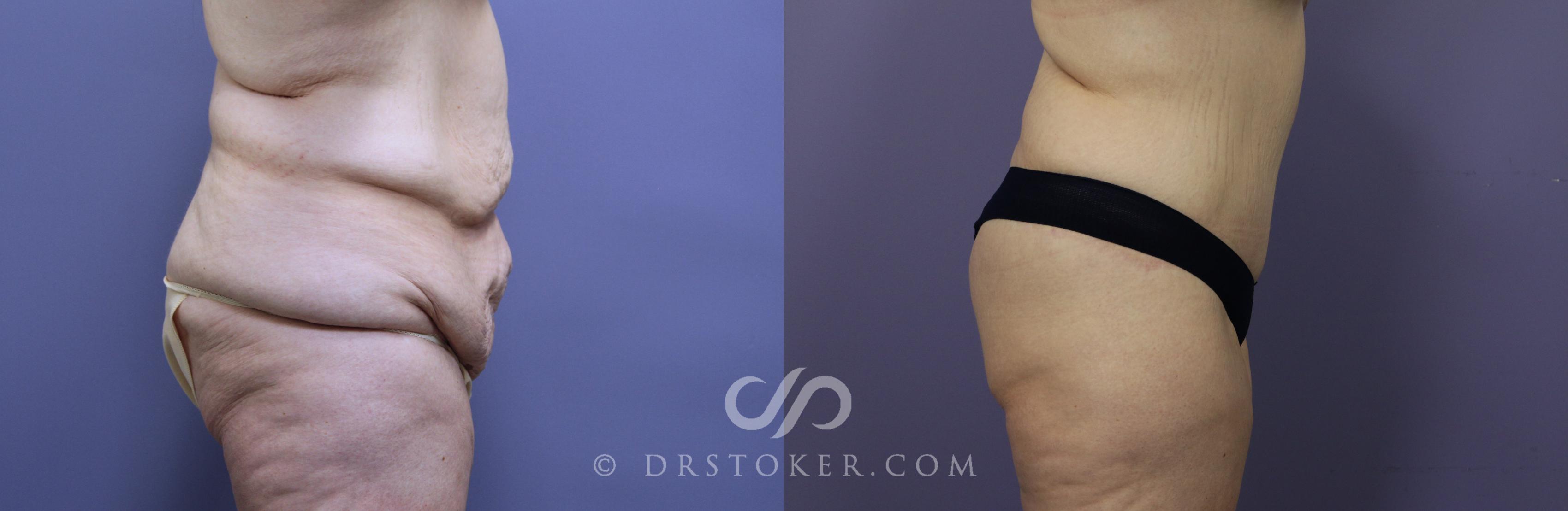 Before & After Posterior Lift Case 1176 View #1 View in Los Angeles, CA