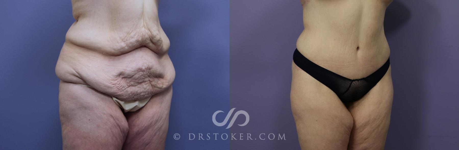 Before & After Posterior Lift Case 1176 View #2 View in Los Angeles, CA