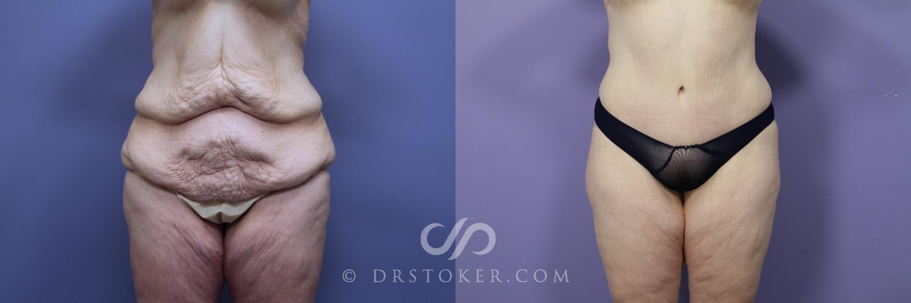 Before & After Posterior Lift Case 1176 View #3 View in Los Angeles, CA