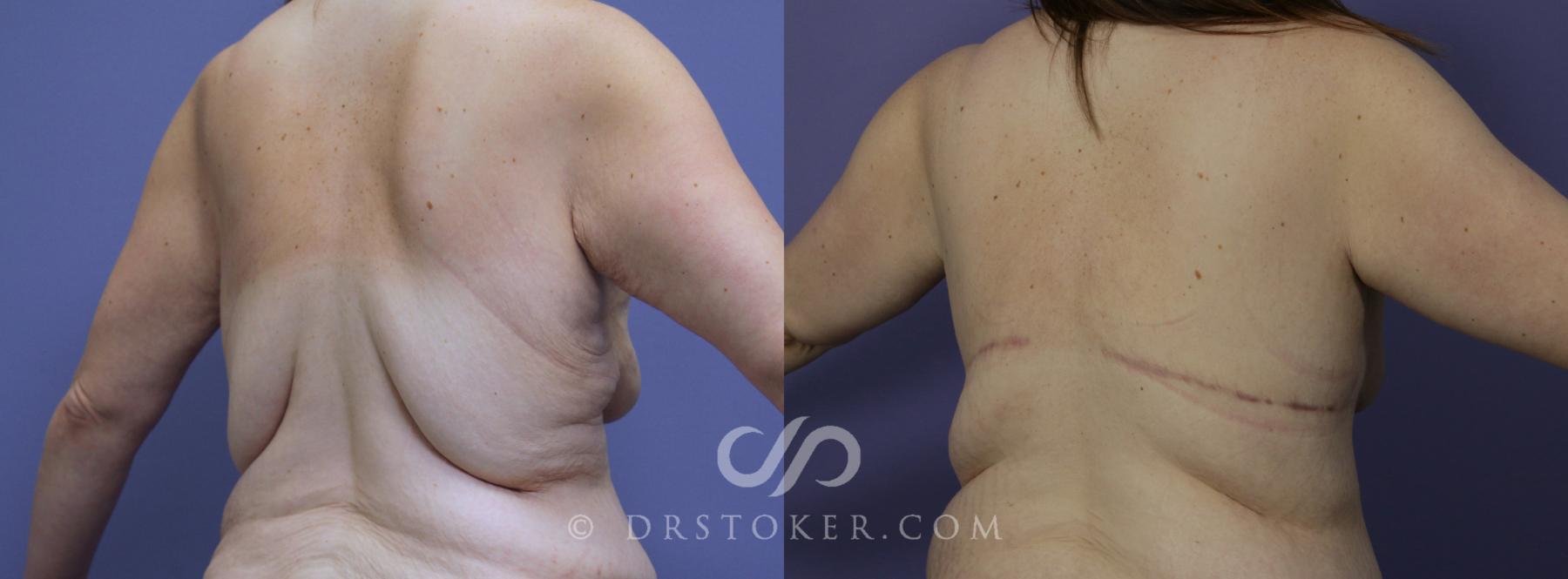 Before & After Posterior Lift Case 1177 View #1 View in Los Angeles, CA