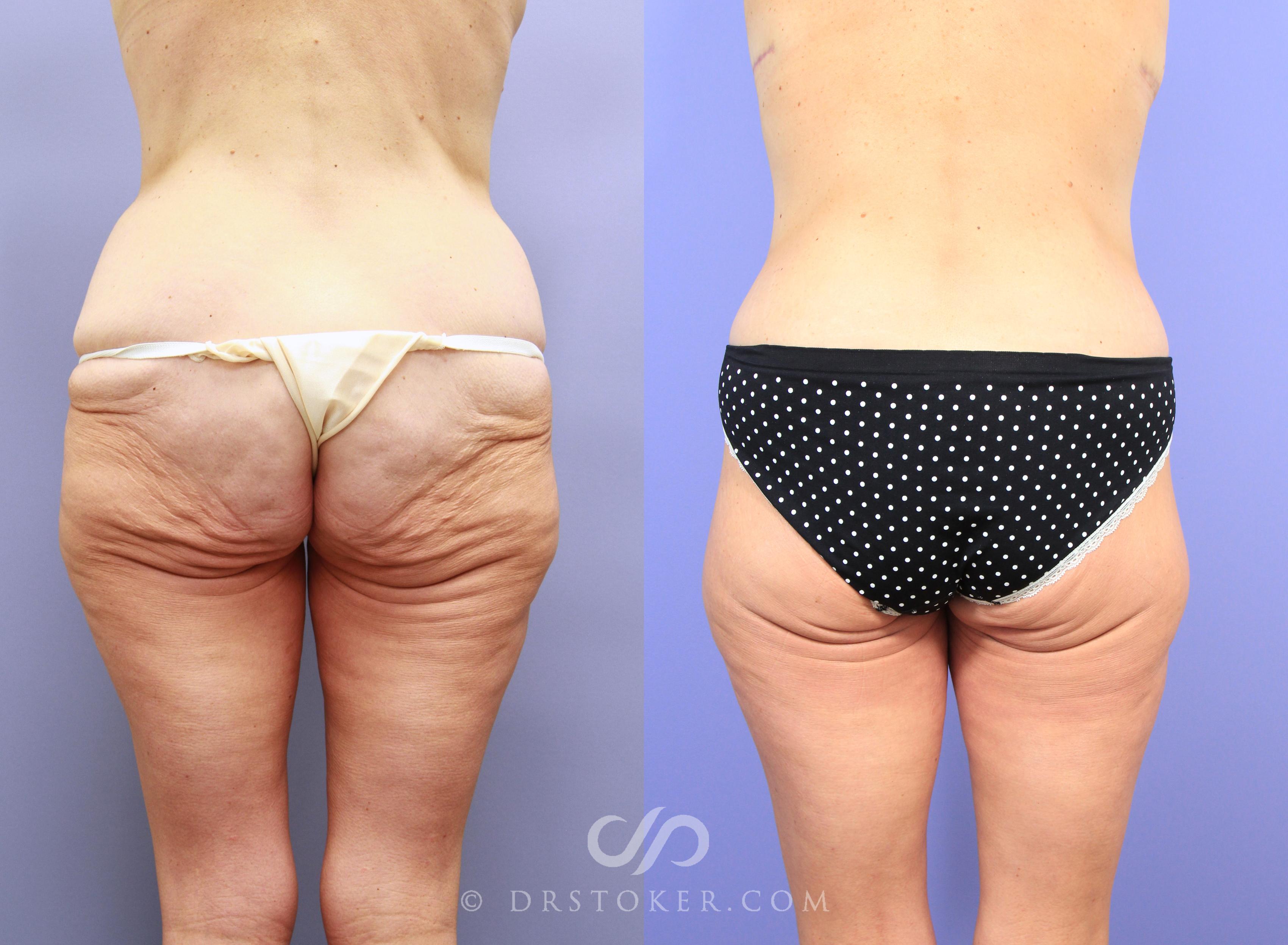 Before & After Posterior Lift Case 1178 View #1 View in Los Angeles, CA