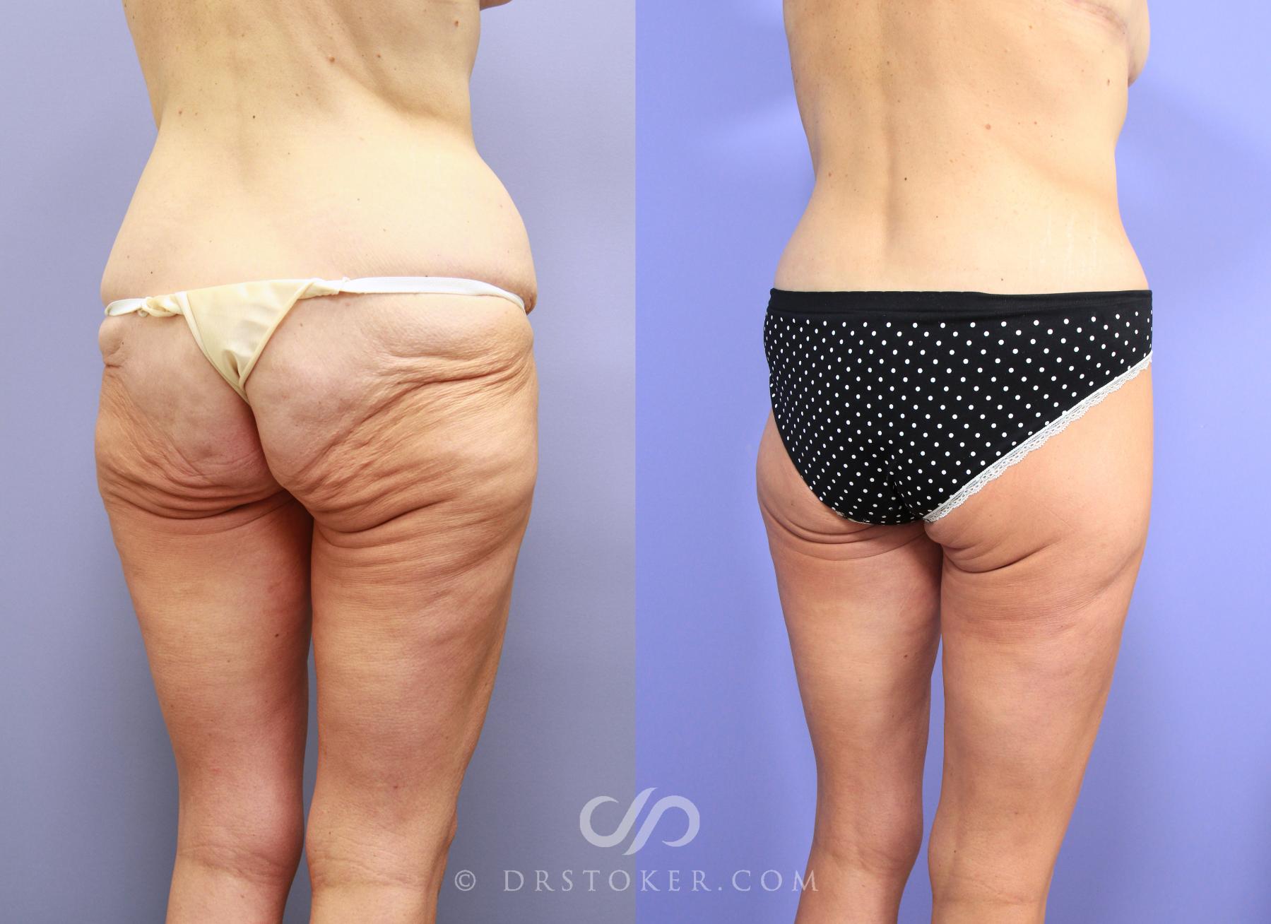 Before & After Posterior Lift Case 1178 View #2 View in Los Angeles, CA