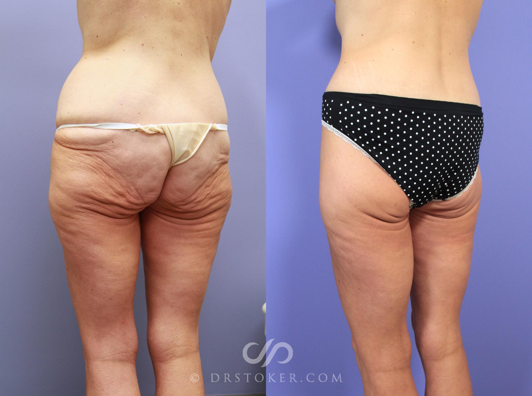 Before & After Posterior Lift Case 1178 View #3 View in Los Angeles, CA