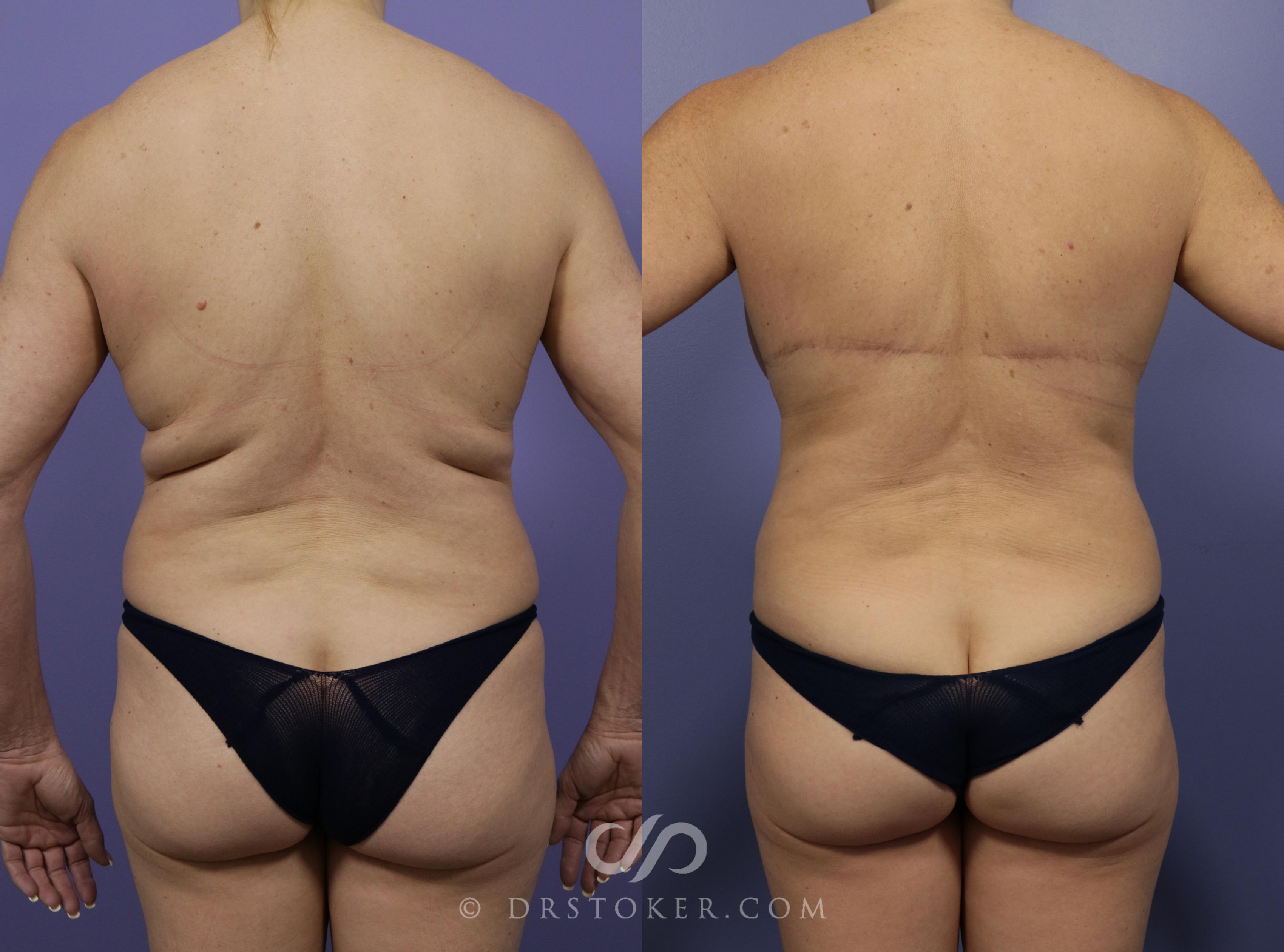 Before & After Posterior Lift Case 1179 View #1 View in Los Angeles, CA