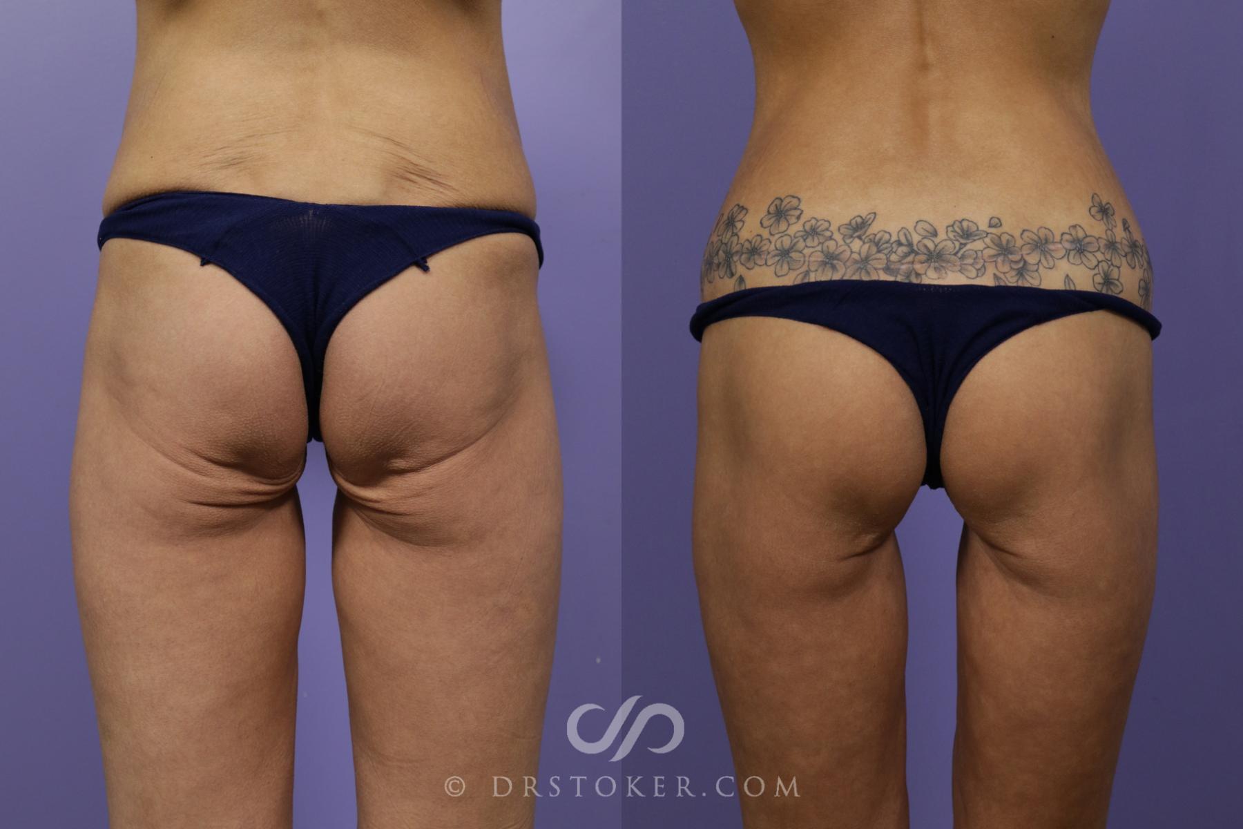 Before & After Posterior Lift Case 1687 View #1 View in Los Angeles, CA