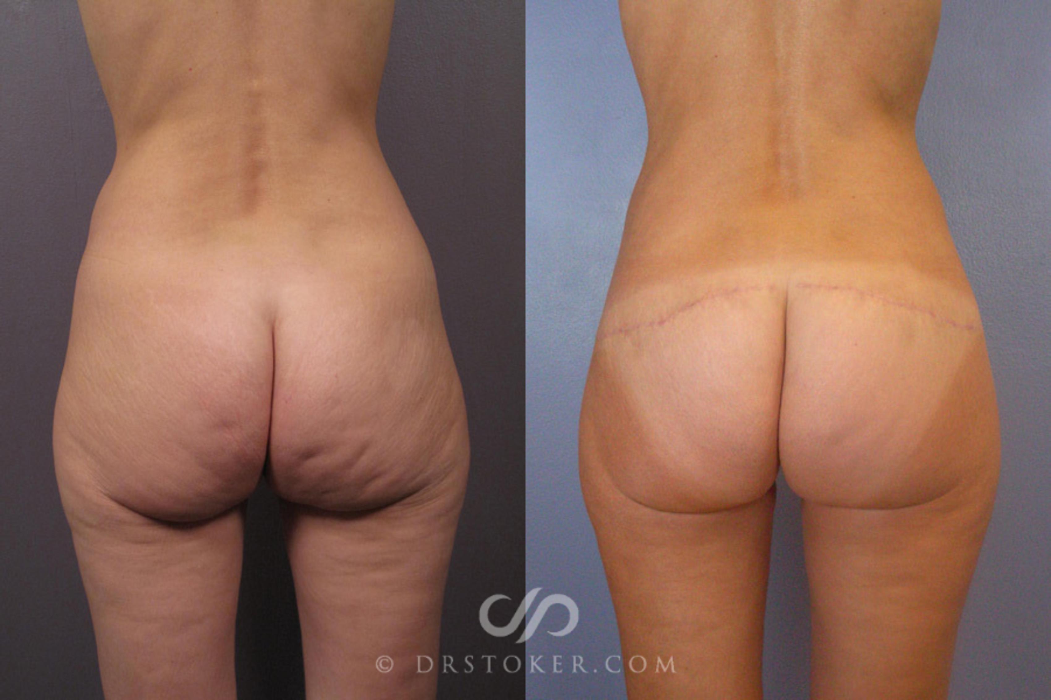 Before & After Body Lift Case 345 View #1 View in Los Angeles, CA