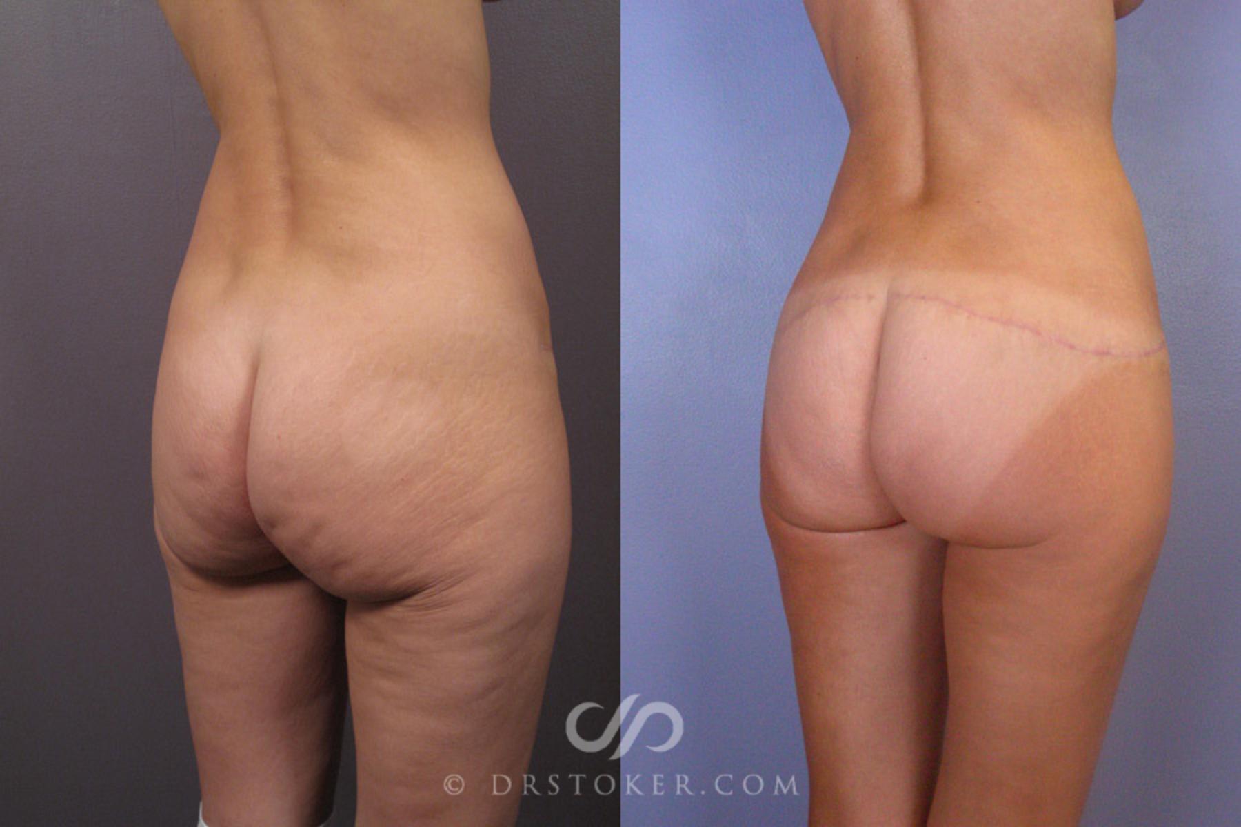 Before & After Posterior Lift Case 345 View #2 View in Los Angeles, CA
