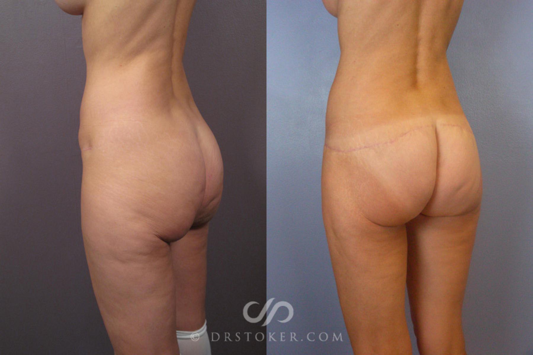 Before & After After Weight Loss Case 345 View #3 View in Los Angeles, CA