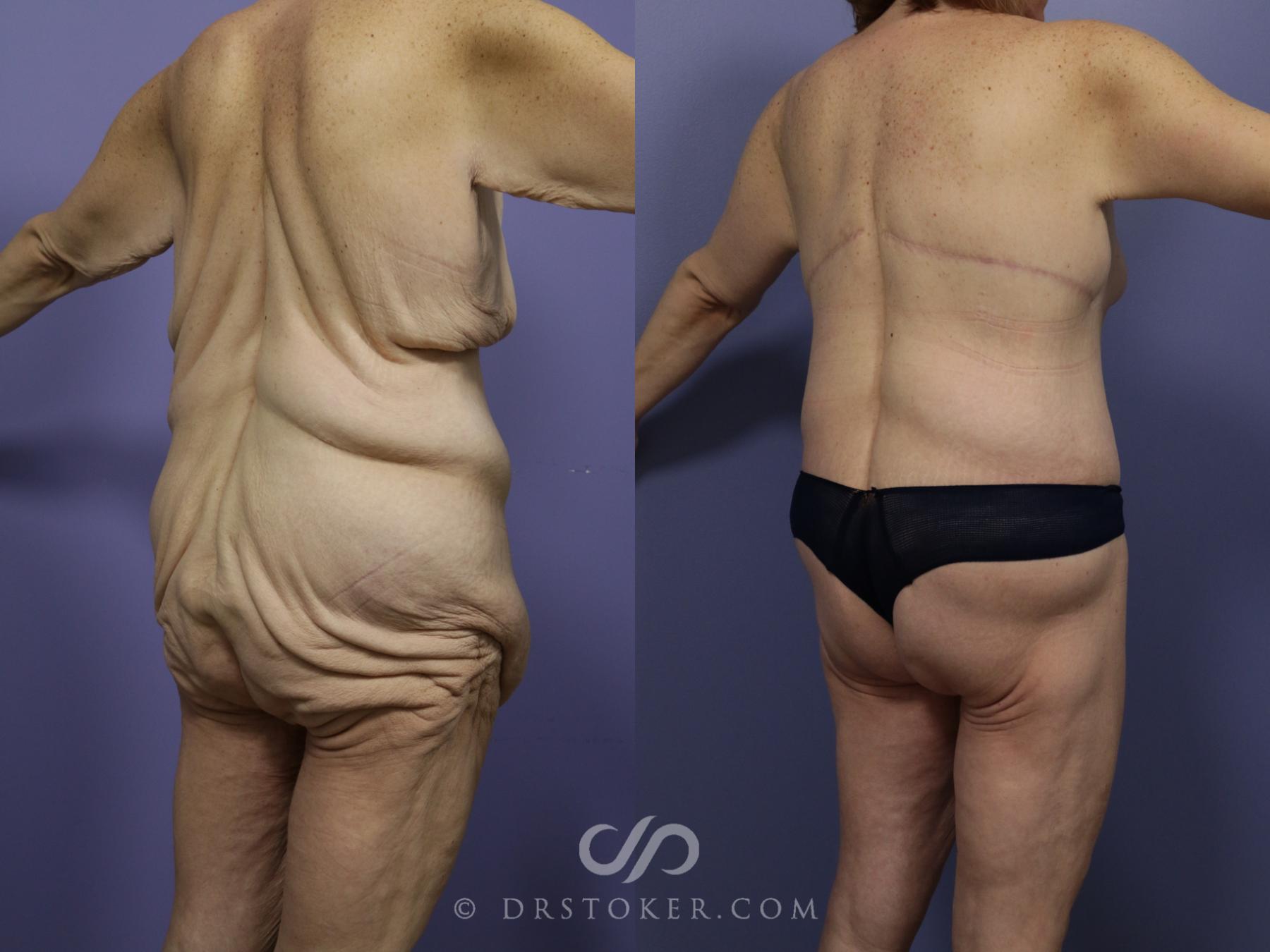 Before & After Posterior Lift Case 667 View #1 View in Los Angeles, CA