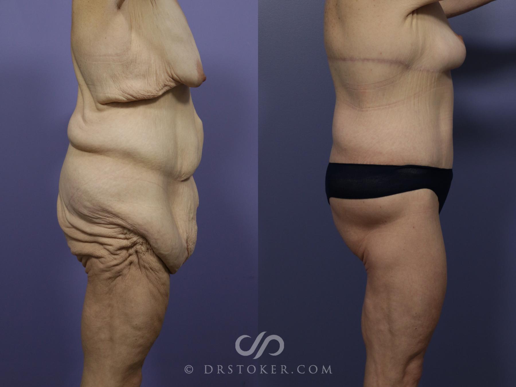 Before & After Posterior Lift Case 667 View #2 View in Los Angeles, CA