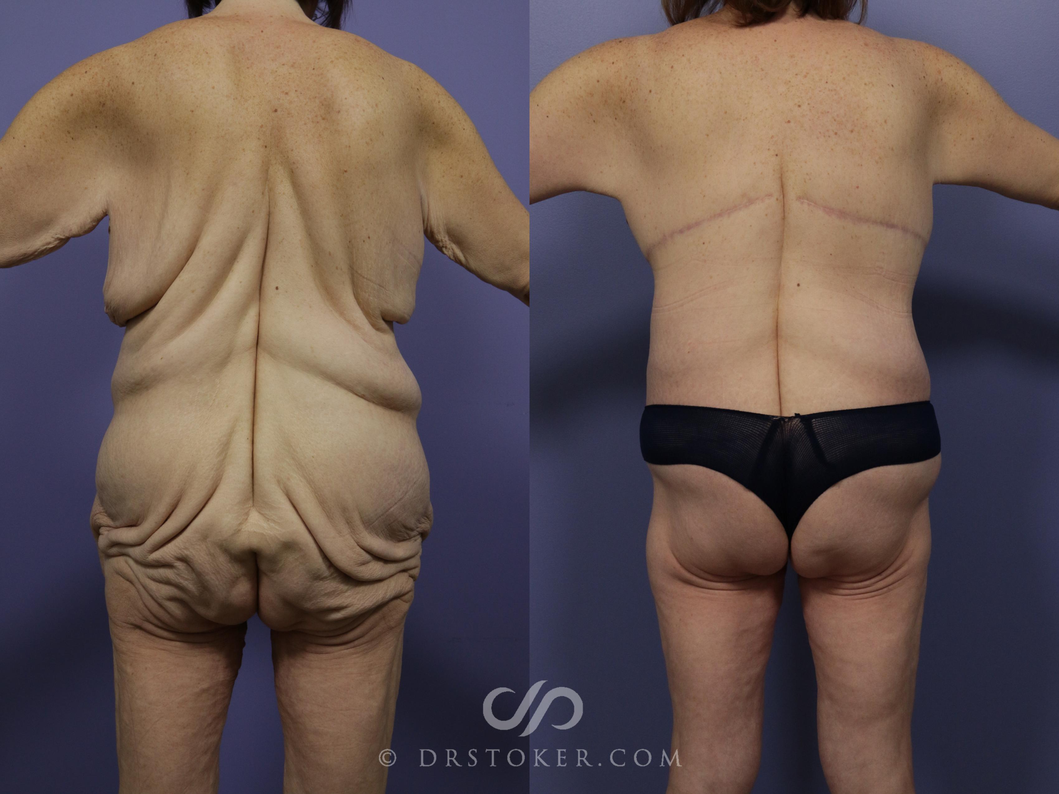 Before & After Posterior Lift Case 668 View #1 View in Los Angeles, CA