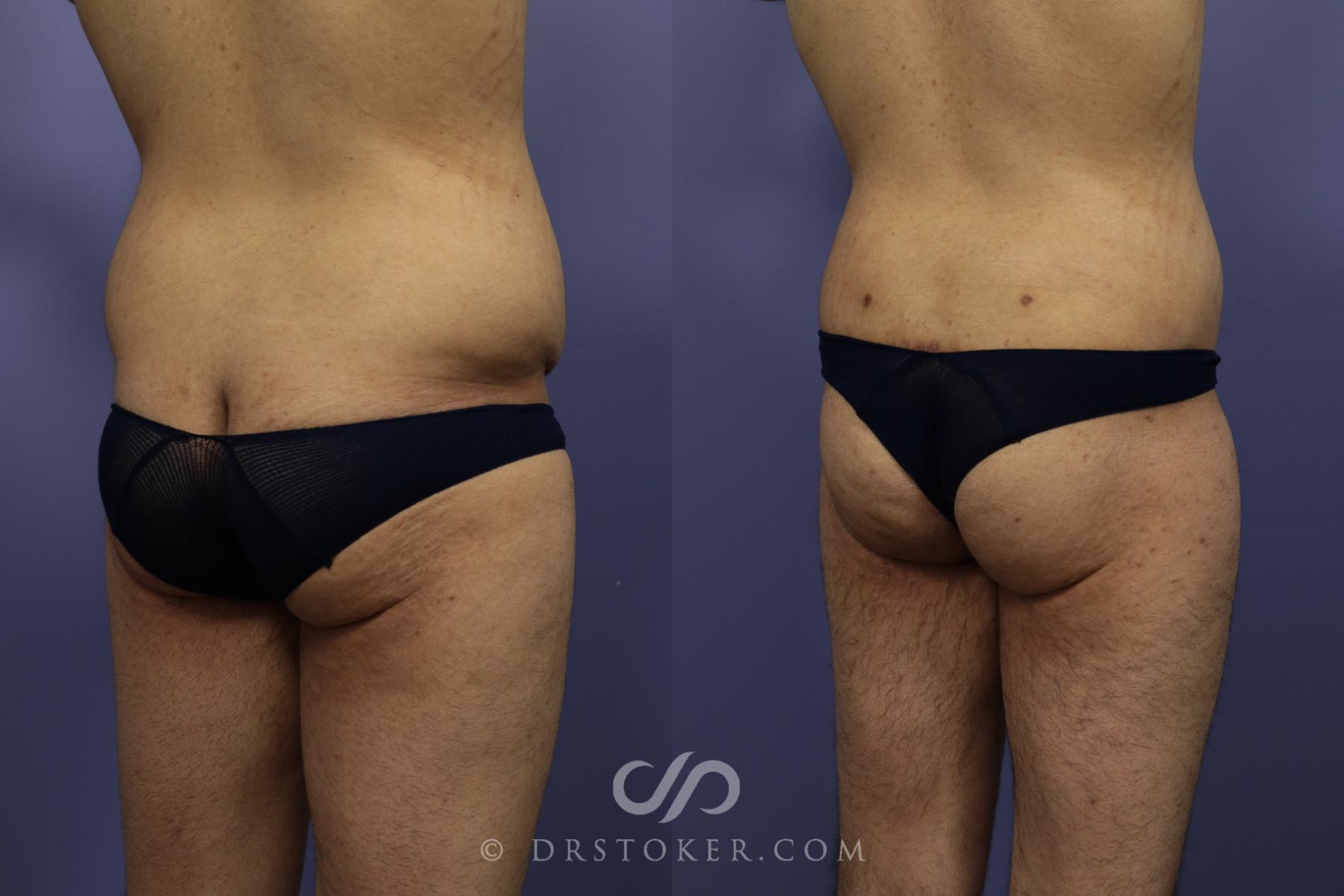 Before & After Posterior Lift Case 669 View #4 View in Los Angeles, CA