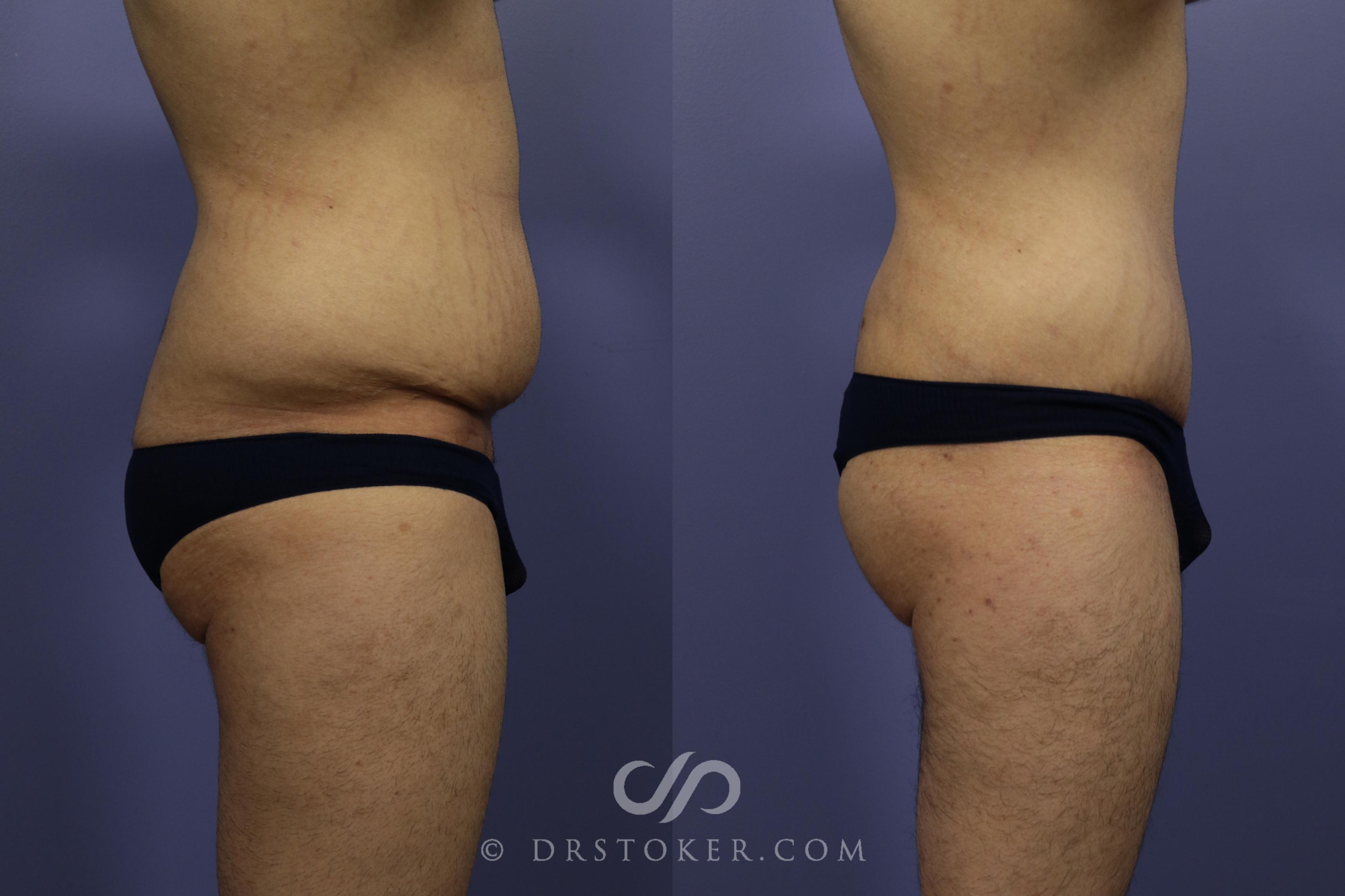 Before & After Posterior Lift Case 669 View #5 View in Los Angeles, CA