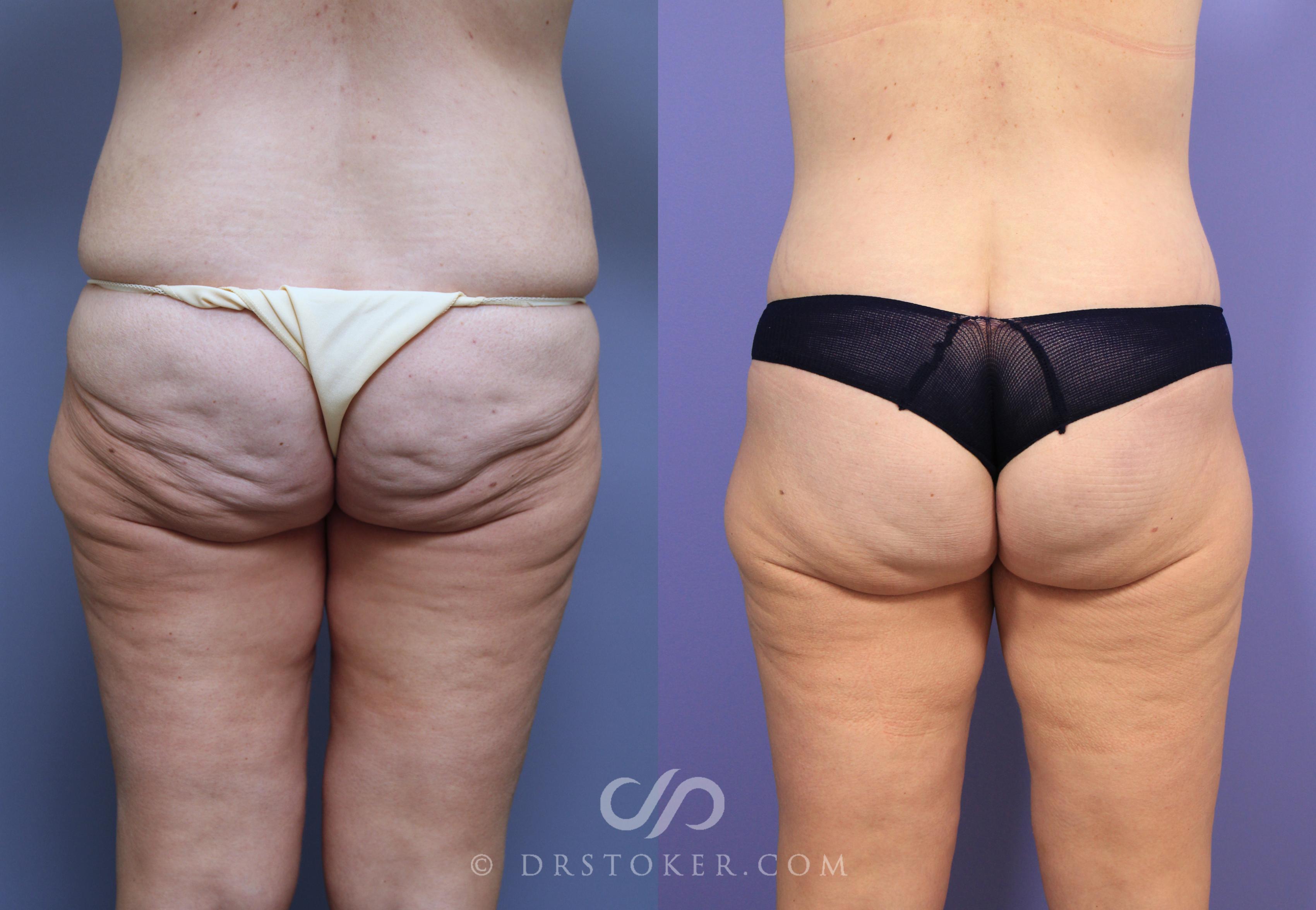Before & After Posterior Lift Case 671 View #1 View in Los Angeles, CA