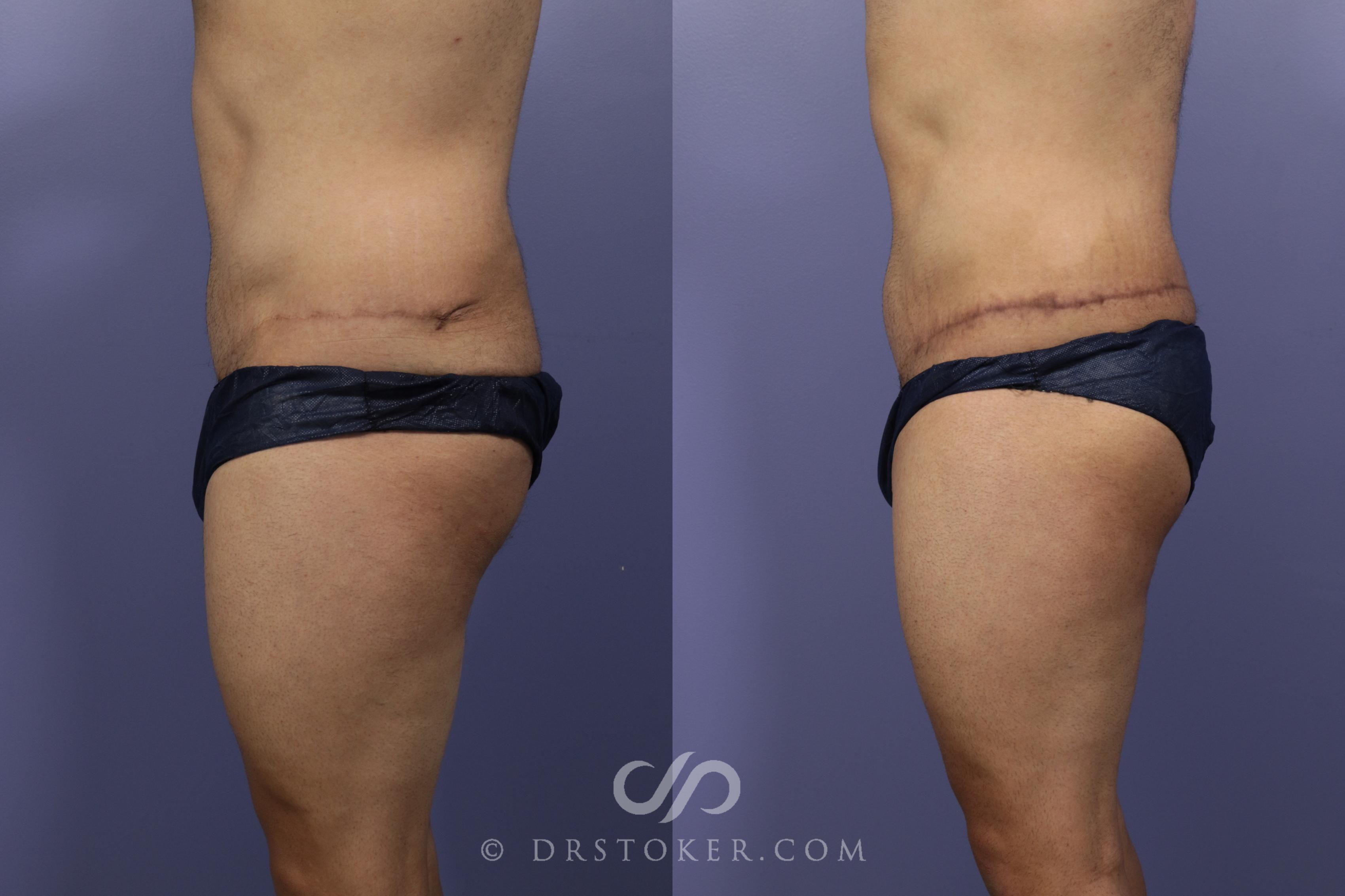 Before & After Posterior Lift Case 674 View #3 View in Los Angeles, CA