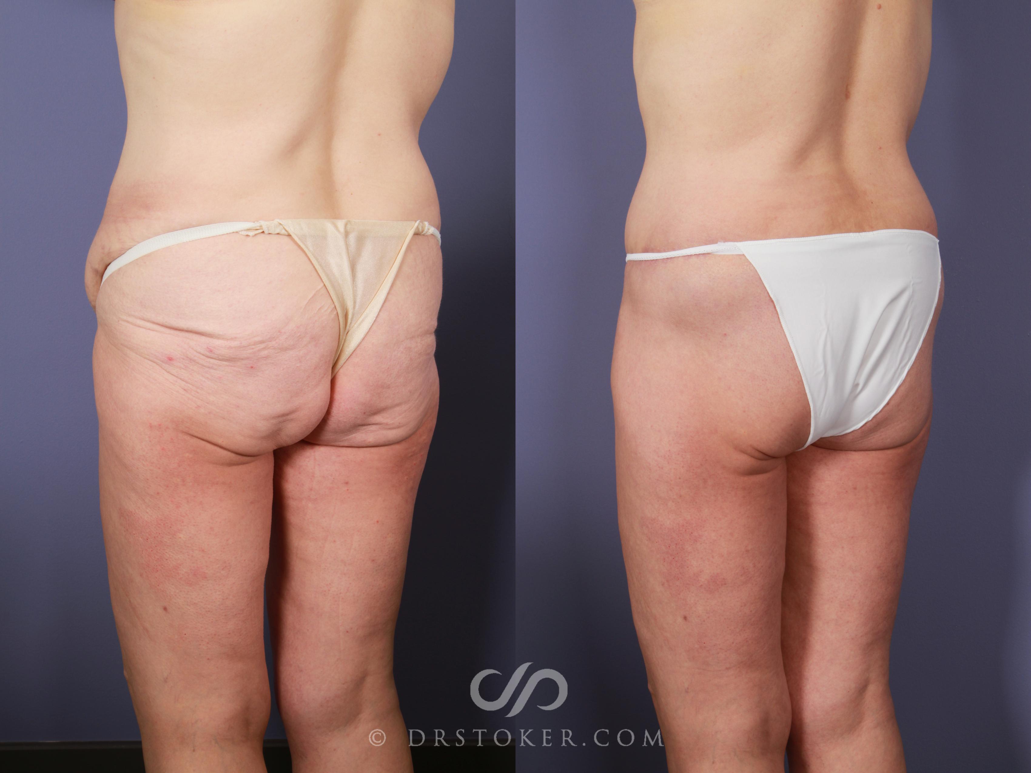 Before & After Posterior Lift Case 675 View #2 View in Los Angeles, CA