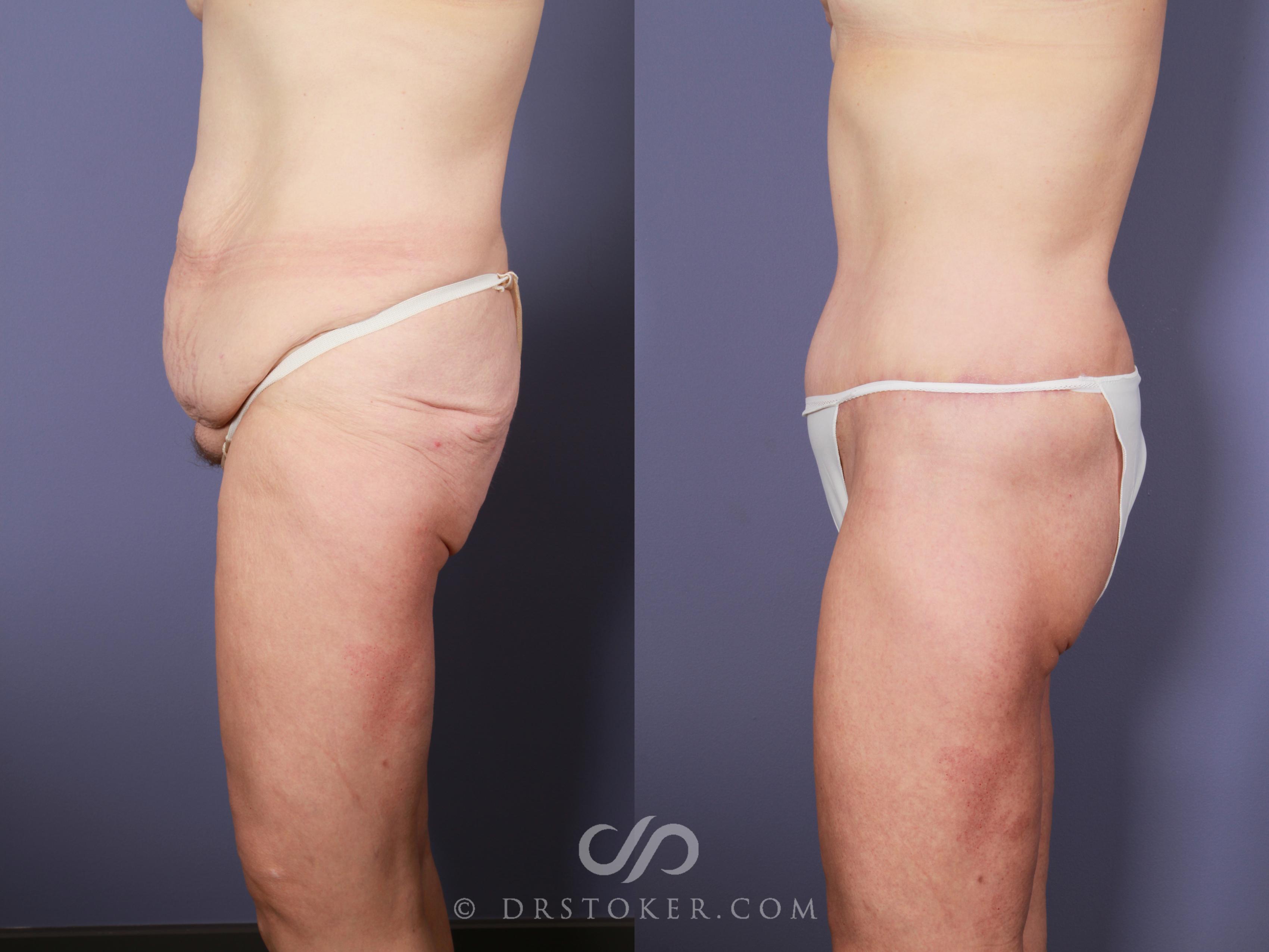 Before & After Posterior Lift Case 675 View #3 View in Los Angeles, CA