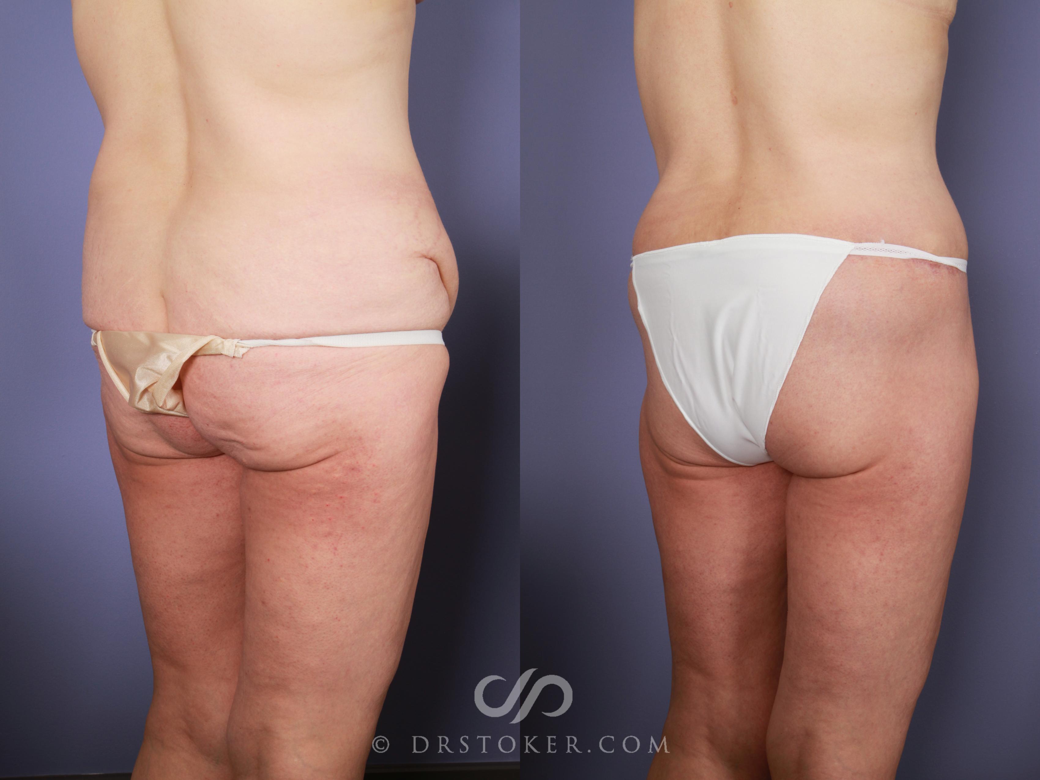 Before & After Posterior Lift Case 675 View #4 View in Los Angeles, CA