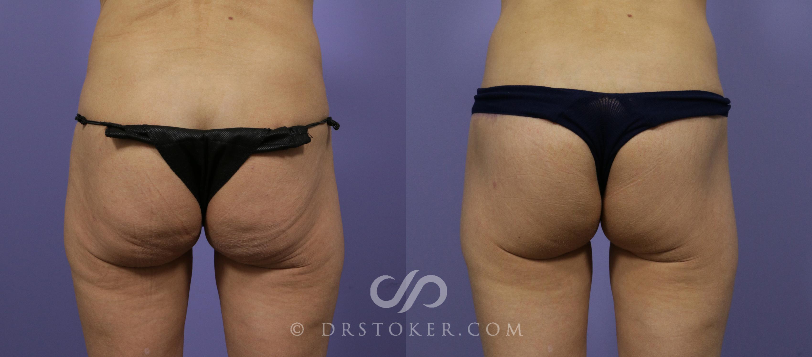 Before & After Posterior Lift Case 679 View #1 View in Los Angeles, CA