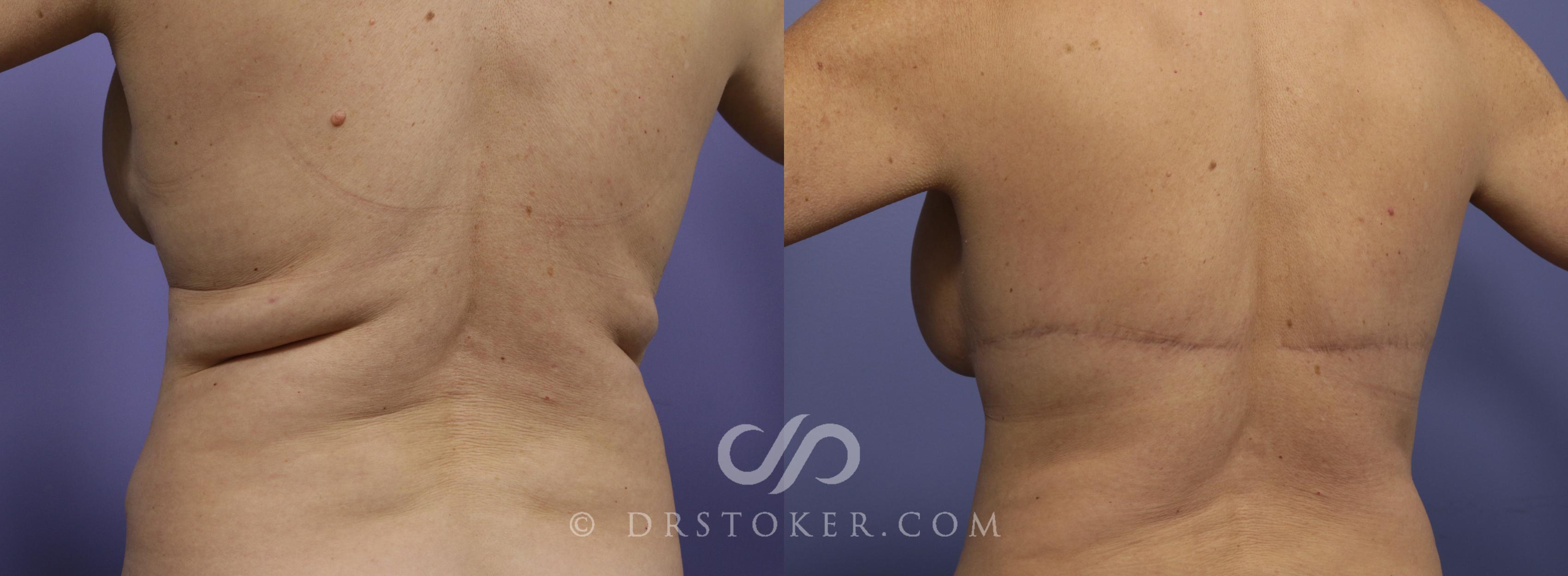 Before & After Posterior Lift Case 682 View #2 View in Los Angeles, CA