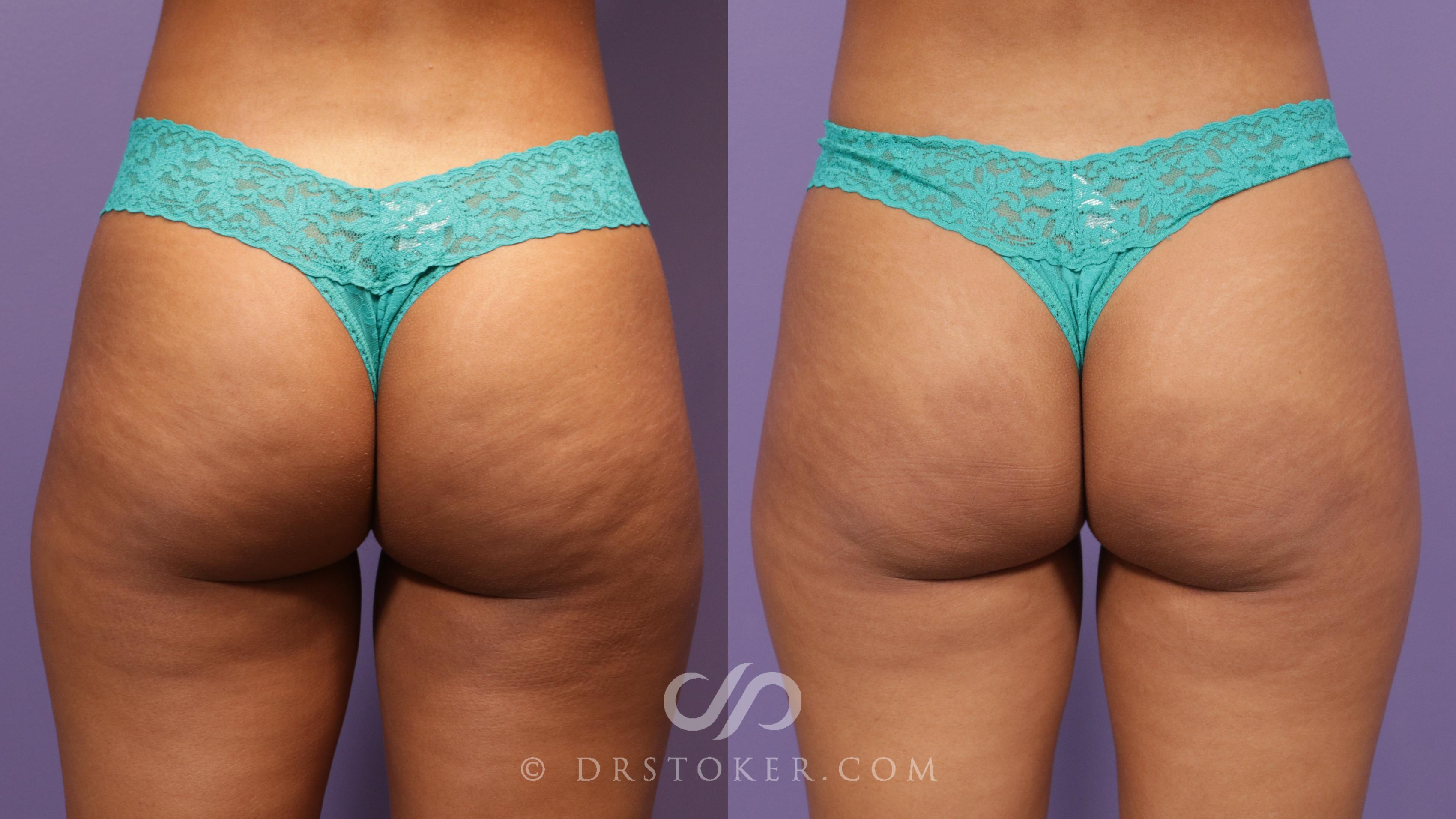 Before & After QWO® Cellulite Treatment Case 1850 Back View in Los Angeles, CA