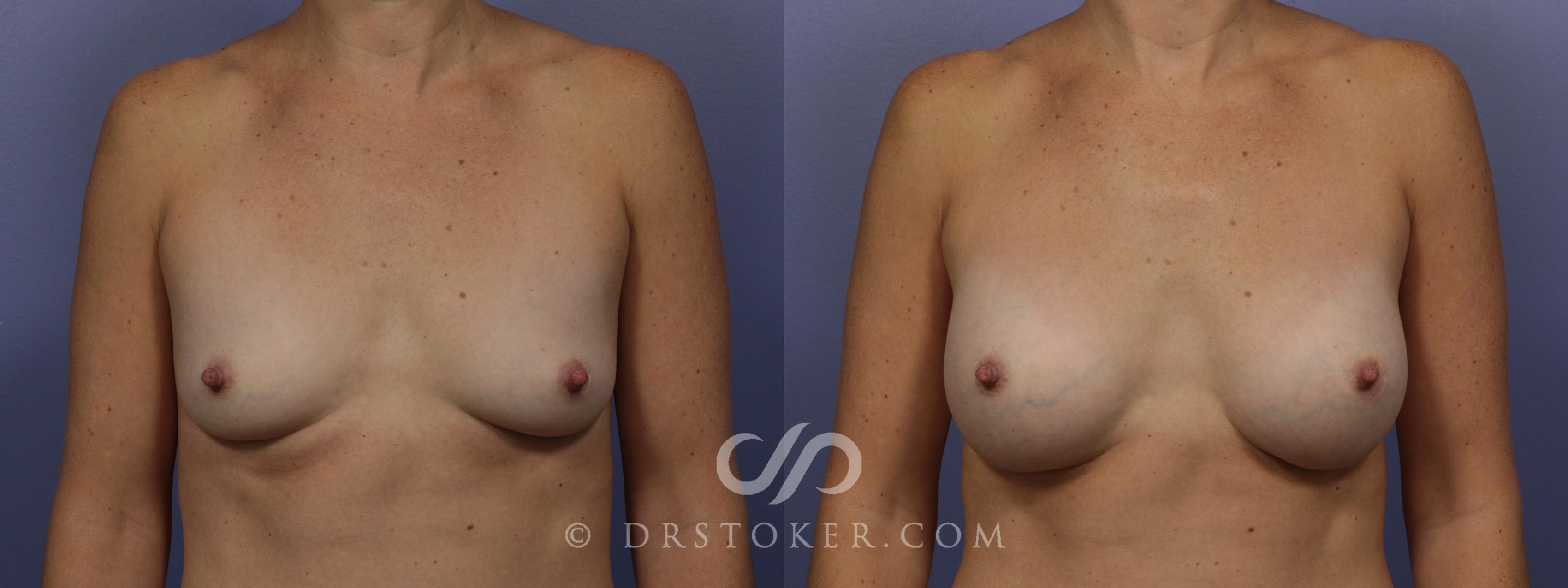 Before & After Breast Augmentation, Rapid Recovery Case 1019 View #1 View in Los Angeles, CA
