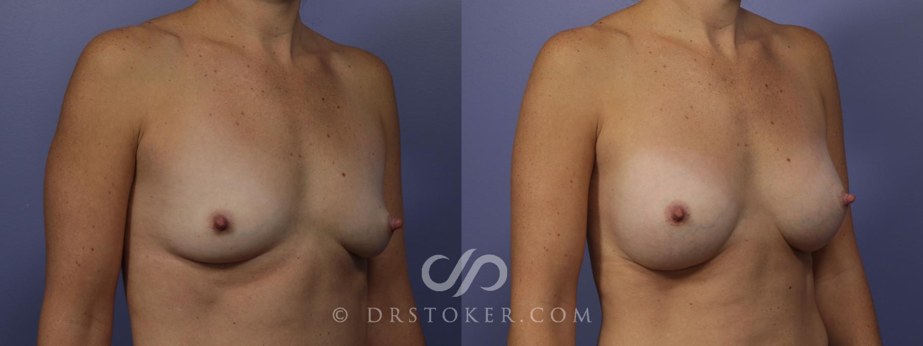 Before & After Breast Augmentation, Rapid Recovery Case 1019 View #2 View in Los Angeles, CA