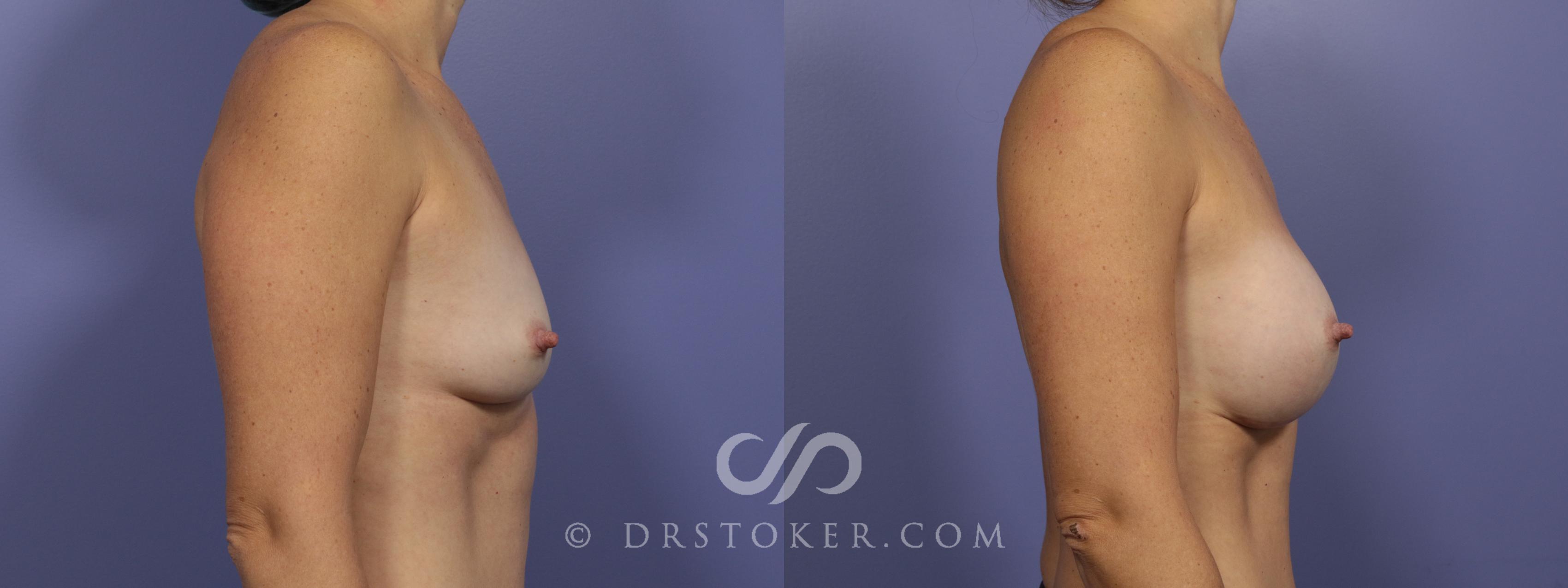 Before & After Breast Augmentation, Rapid Recovery Case 1019 View #3 View in Los Angeles, CA