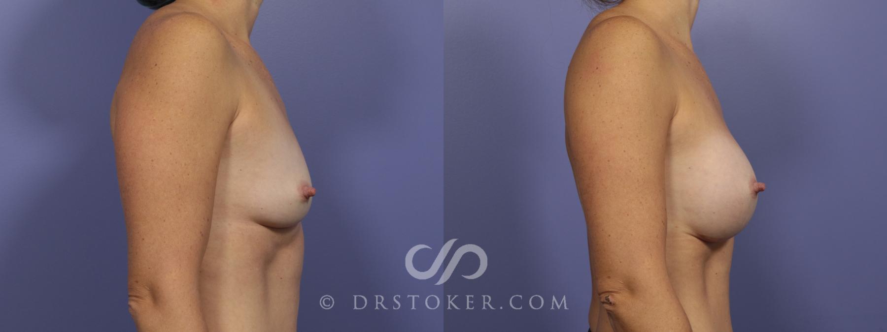 Before & After Breast Augmentation, Rapid Recovery Case 1019 View #3 View in Los Angeles, CA