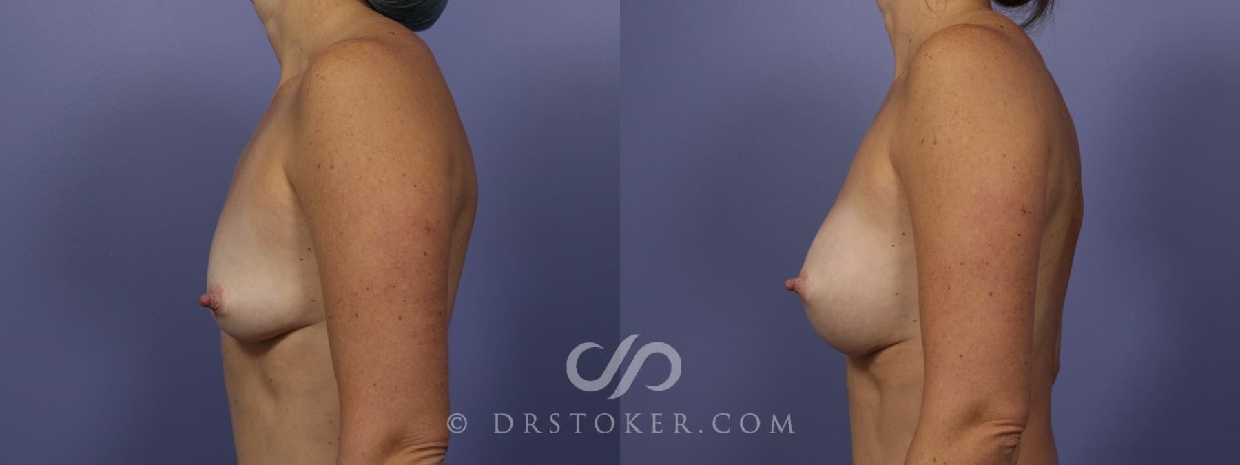 Before & After Breast Augmentation, Rapid Recovery Case 1019 View #4 View in Los Angeles, CA