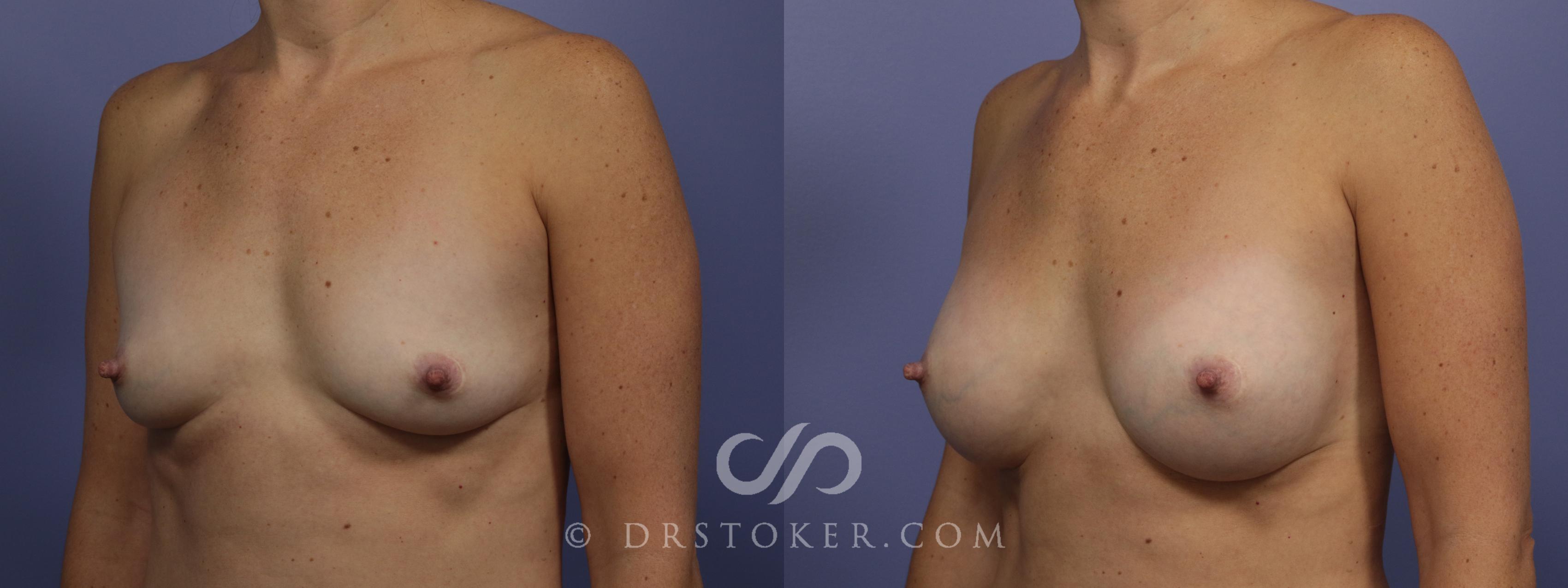 Before & After Breast Augmentation, Rapid Recovery Case 1019 View #5 View in Los Angeles, CA