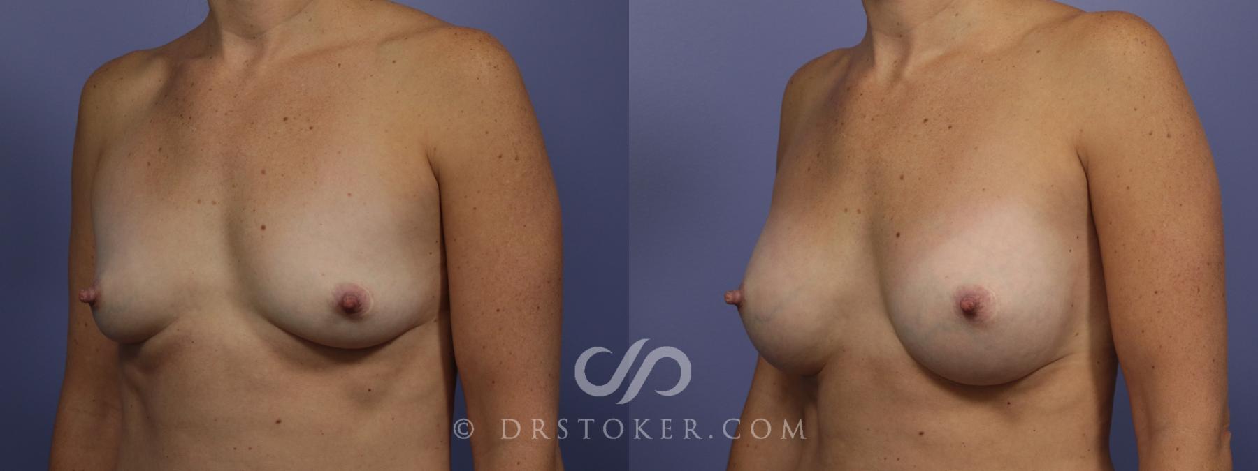 Before & After Breast Augmentation, Rapid Recovery Case 1019 View #5 View in Los Angeles, CA