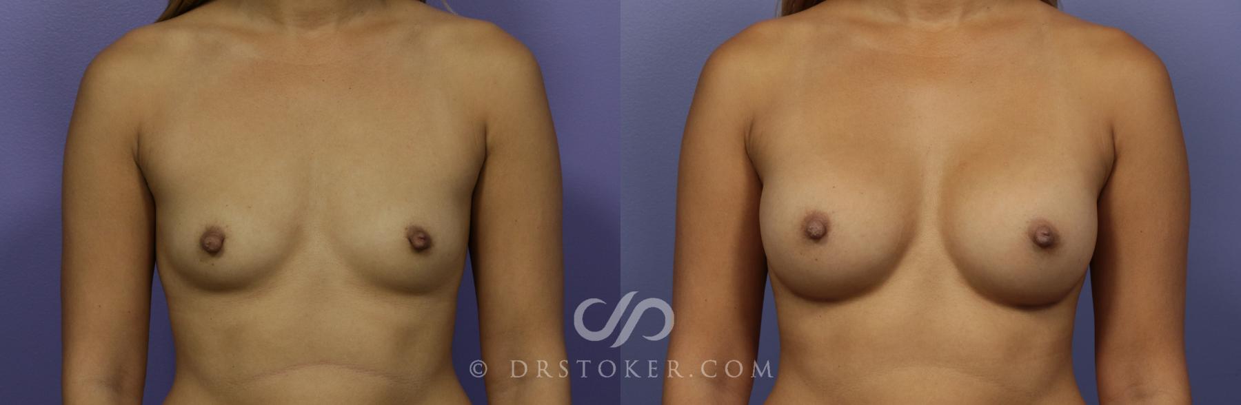 Before & After Breast Augmentation, Rapid Recovery Case 1020 View #1 View in Los Angeles, CA