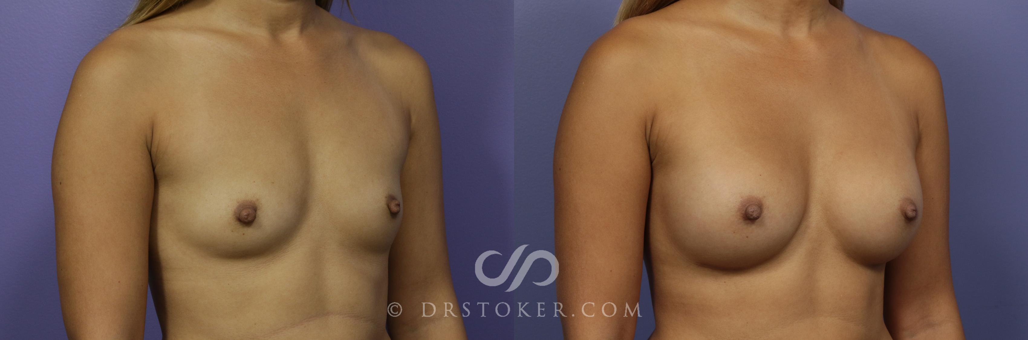 Before & After Breast Augmentation, Rapid Recovery Case 1020 View #2 View in Los Angeles, CA