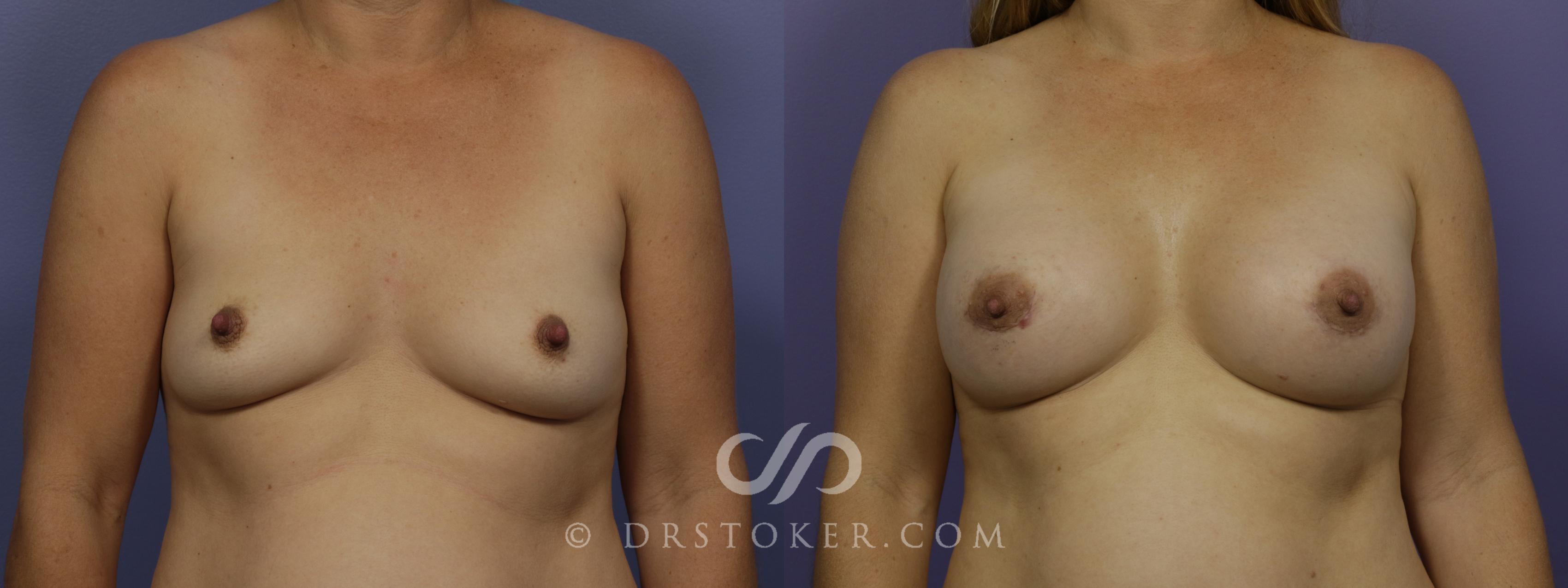 Before & After Breast Augmentation, Rapid Recovery Case 1021 View #1 View in Los Angeles, CA
