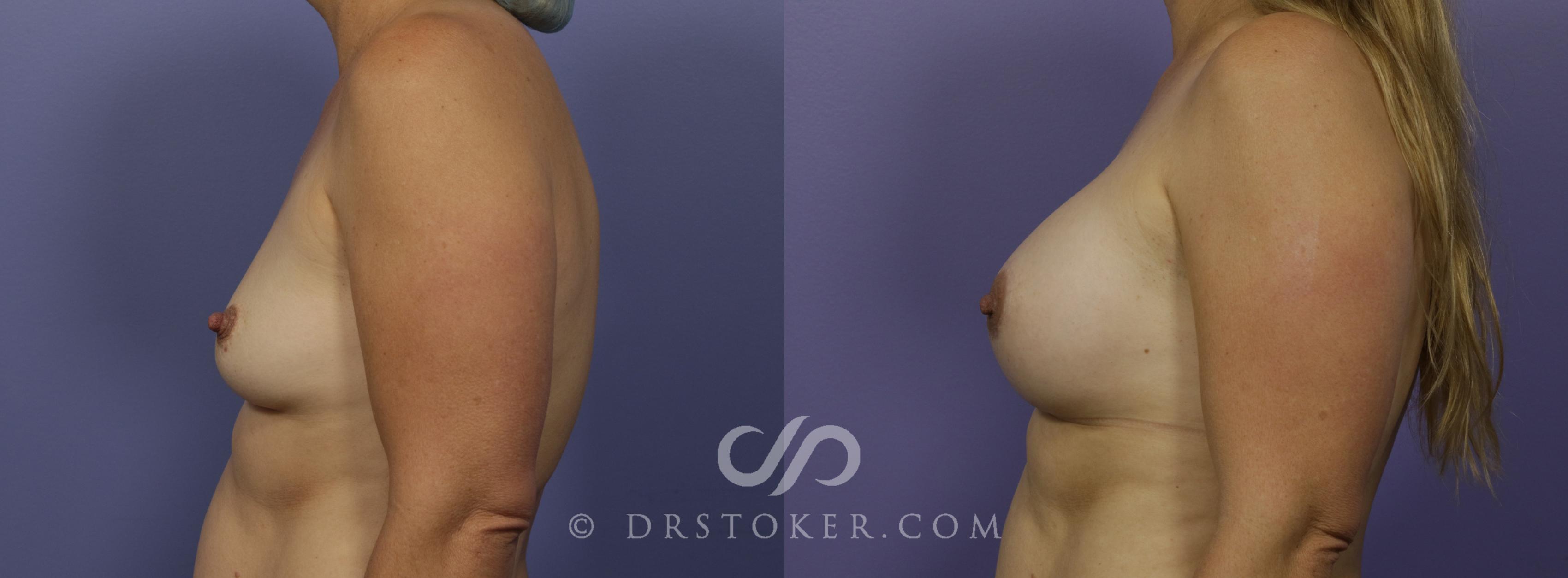 Before & After Breast Augmentation, Rapid Recovery Case 1021 View #2 View in Los Angeles, CA