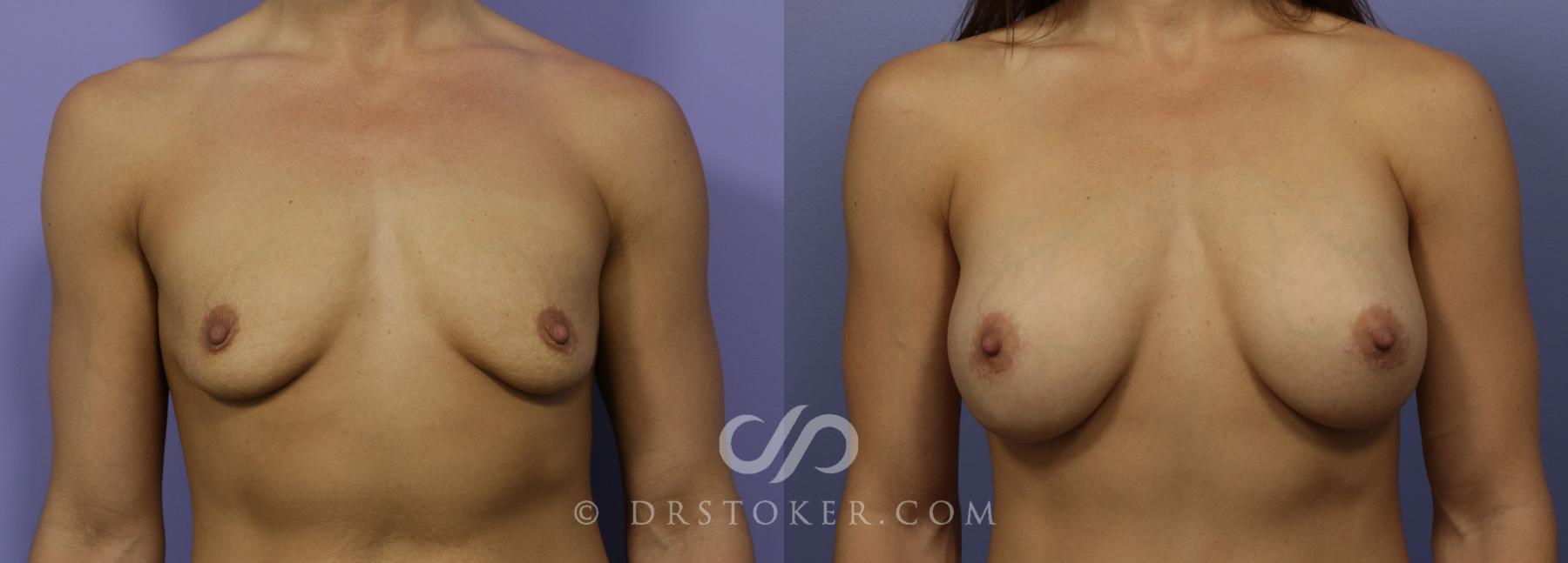 Before & After Breast Augmentation, Rapid Recovery Case 1022 View #1 View in Los Angeles, CA