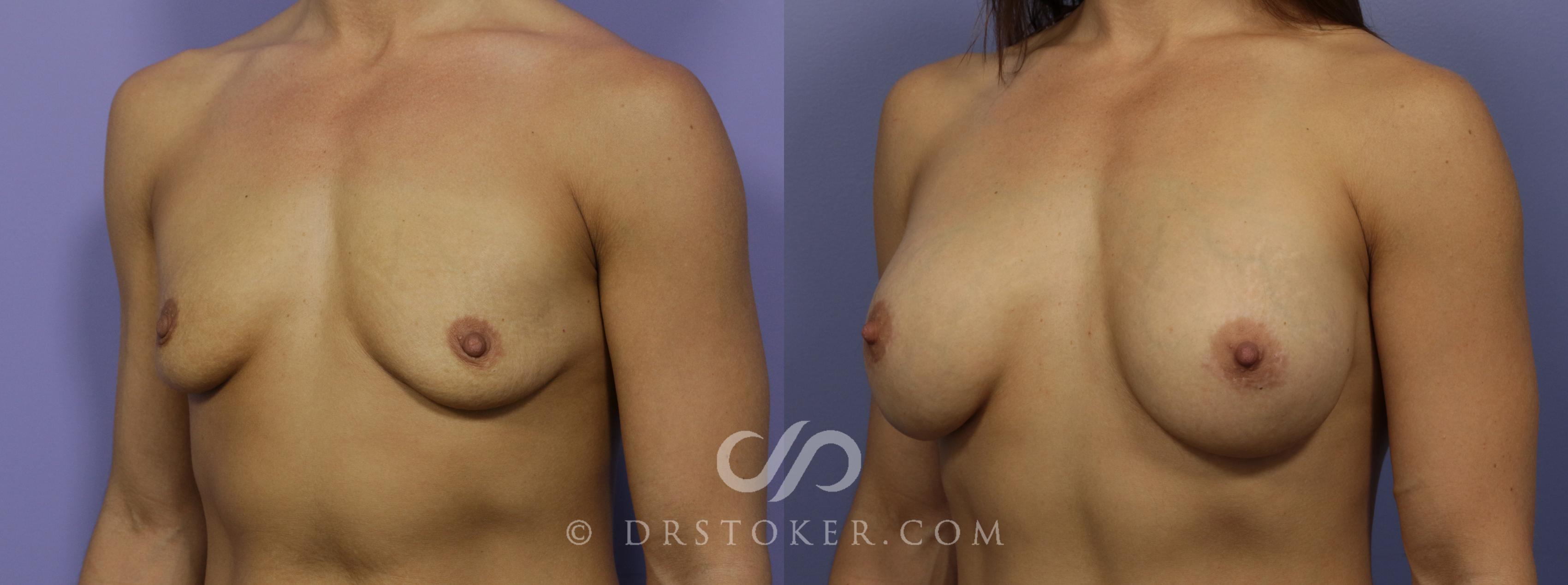 Before & After Breast Augmentation, Rapid Recovery Case 1022 View #3 View in Los Angeles, CA