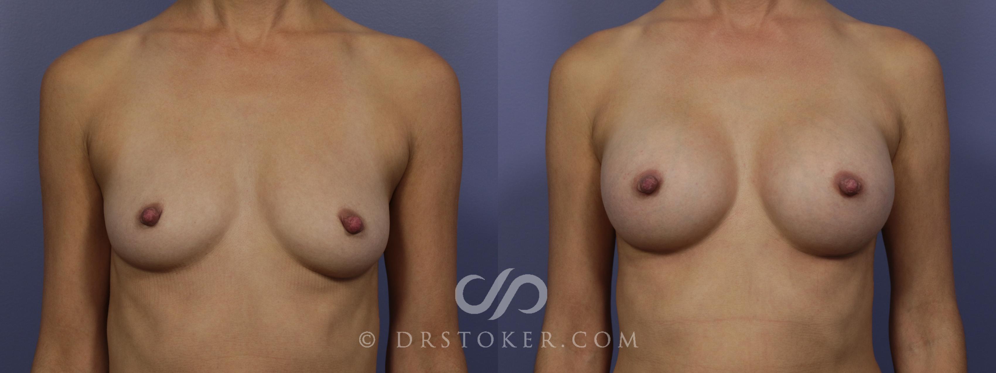 Before & After Breast Augmentation, Rapid Recovery Case 1023 View #1 View in Los Angeles, CA