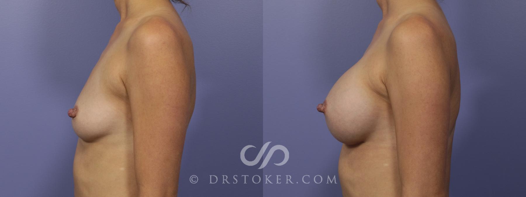 Before & After Breast Augmentation, Rapid Recovery Case 1023 View #2 View in Los Angeles, CA