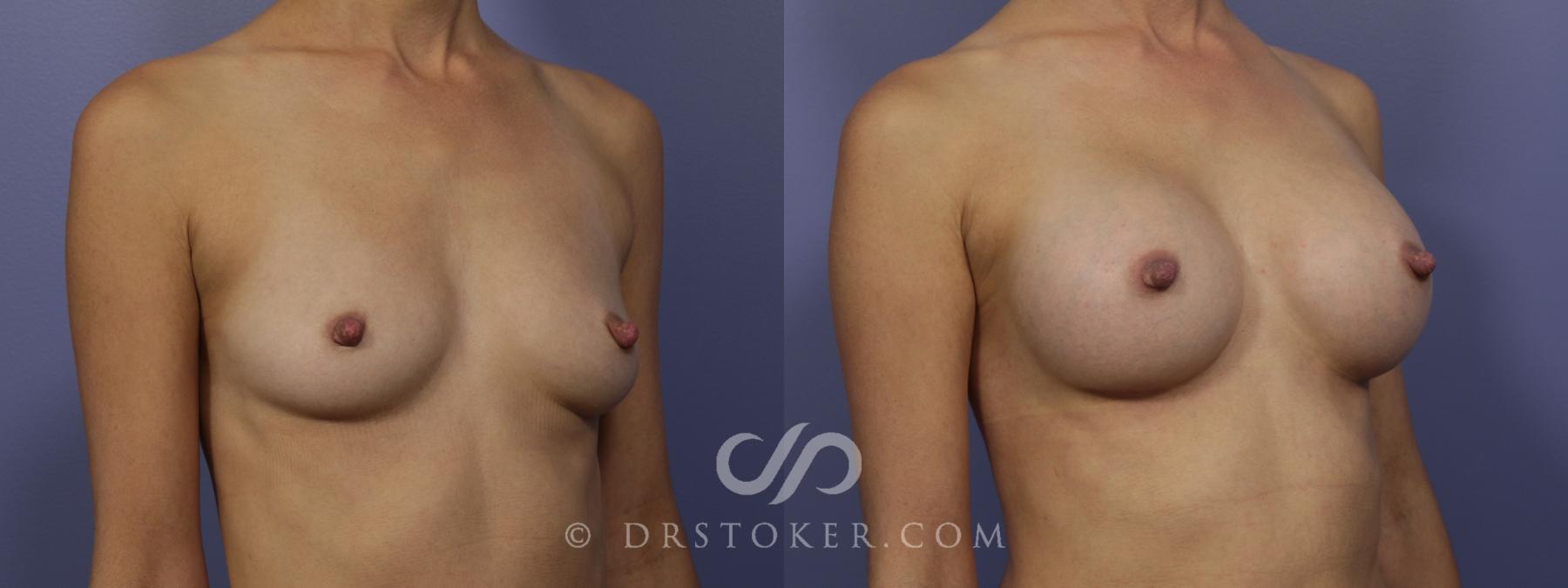 Before & After Breast Augmentation, Rapid Recovery Case 1023 View #3 View in Los Angeles, CA