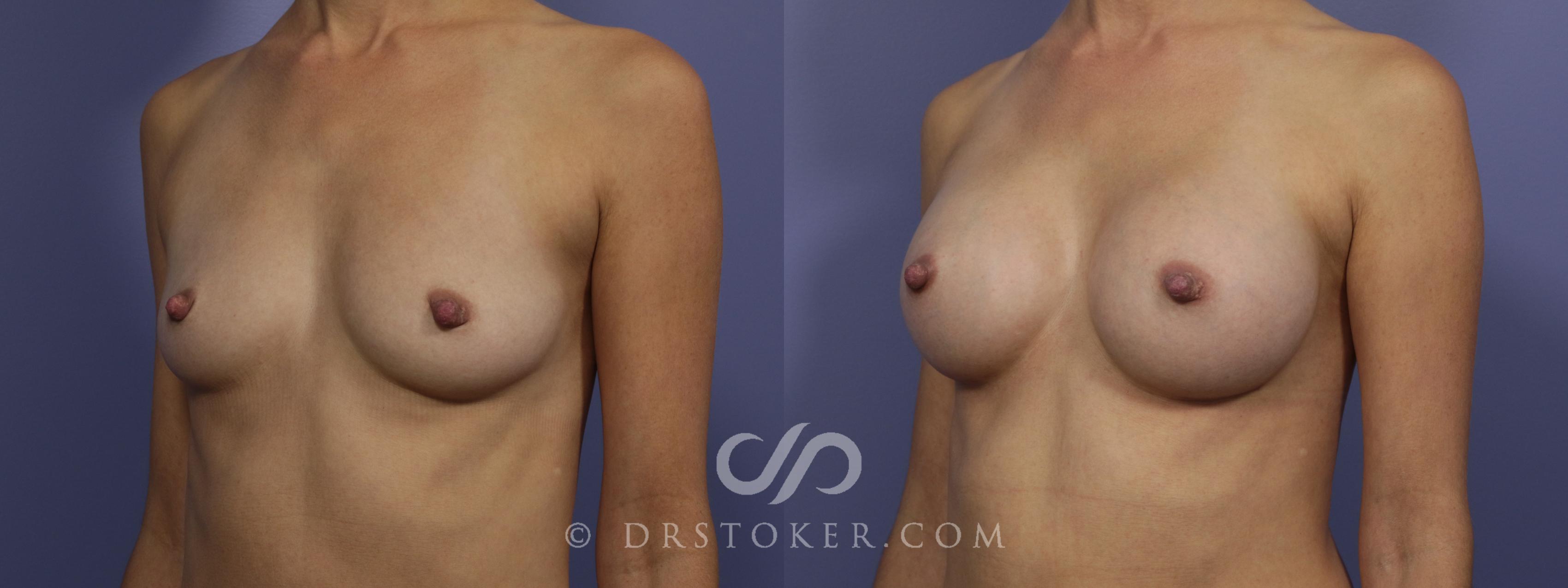 Before & After Breast Augmentation, Rapid Recovery Case 1023 View #4 View in Los Angeles, CA