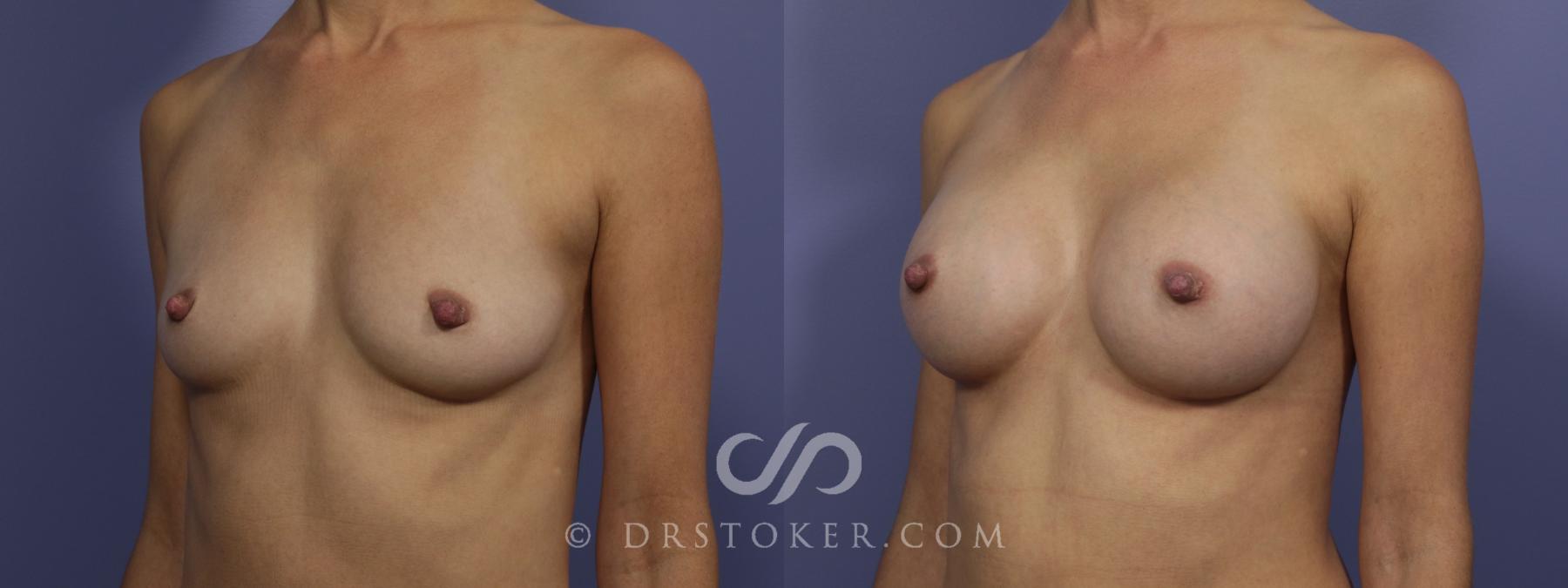 Before & After Breast Augmentation, Rapid Recovery Case 1023 View #4 View in Los Angeles, CA