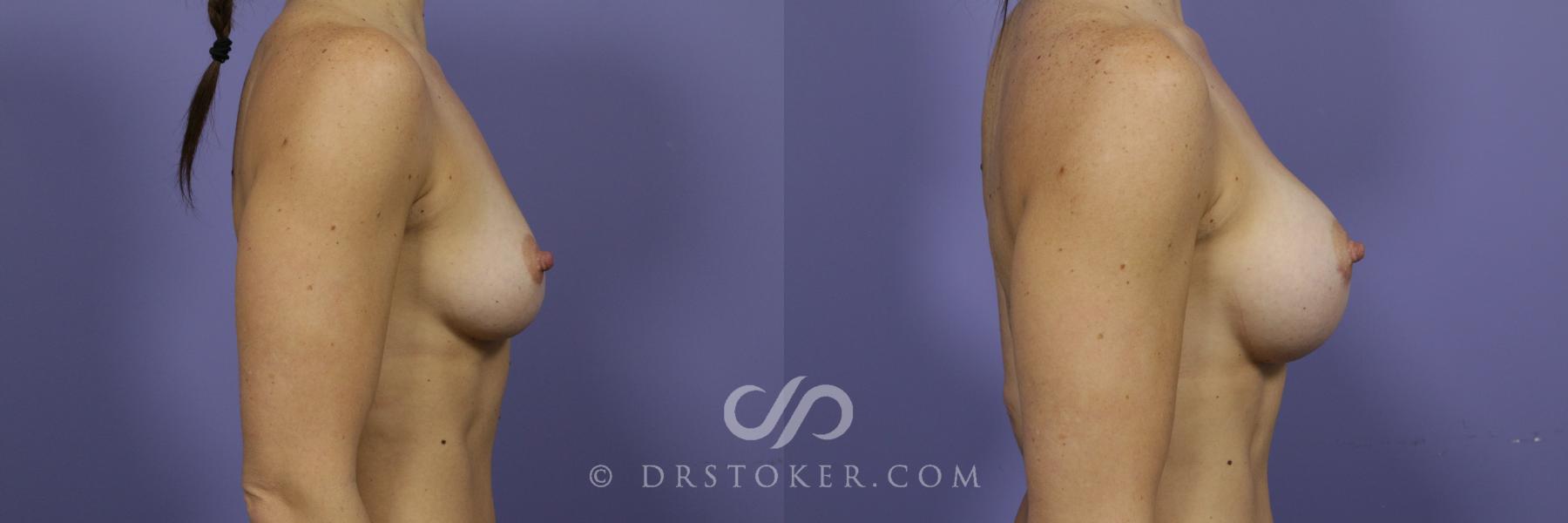 Before & After Breast Augmentation, Rapid Recovery Case 1024 View #2 View in Los Angeles, CA