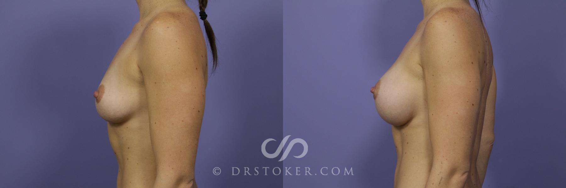 Before & After Breast Augmentation, Rapid Recovery Case 1024 View #3 View in Los Angeles, CA