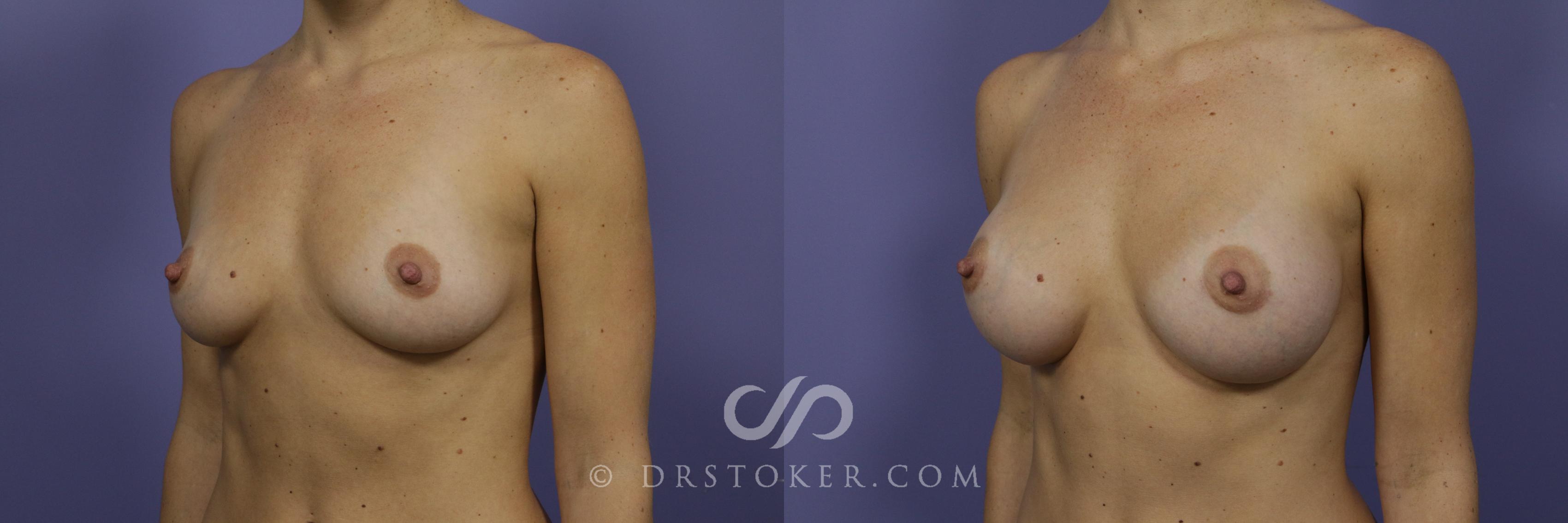 Before & After Breast Augmentation, Rapid Recovery Case 1024 View #4 View in Los Angeles, CA