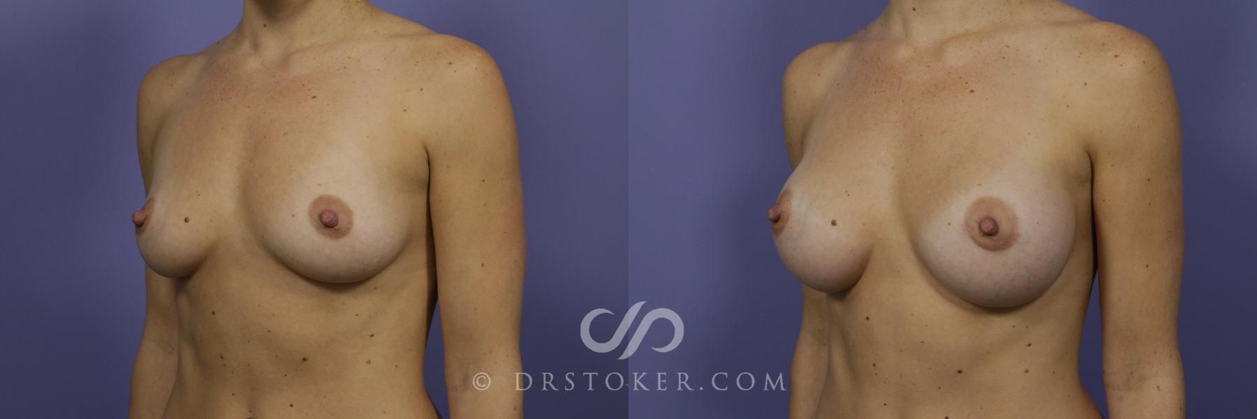 Before & After Breast Augmentation, Rapid Recovery Case 1024 View #4 View in Los Angeles, CA