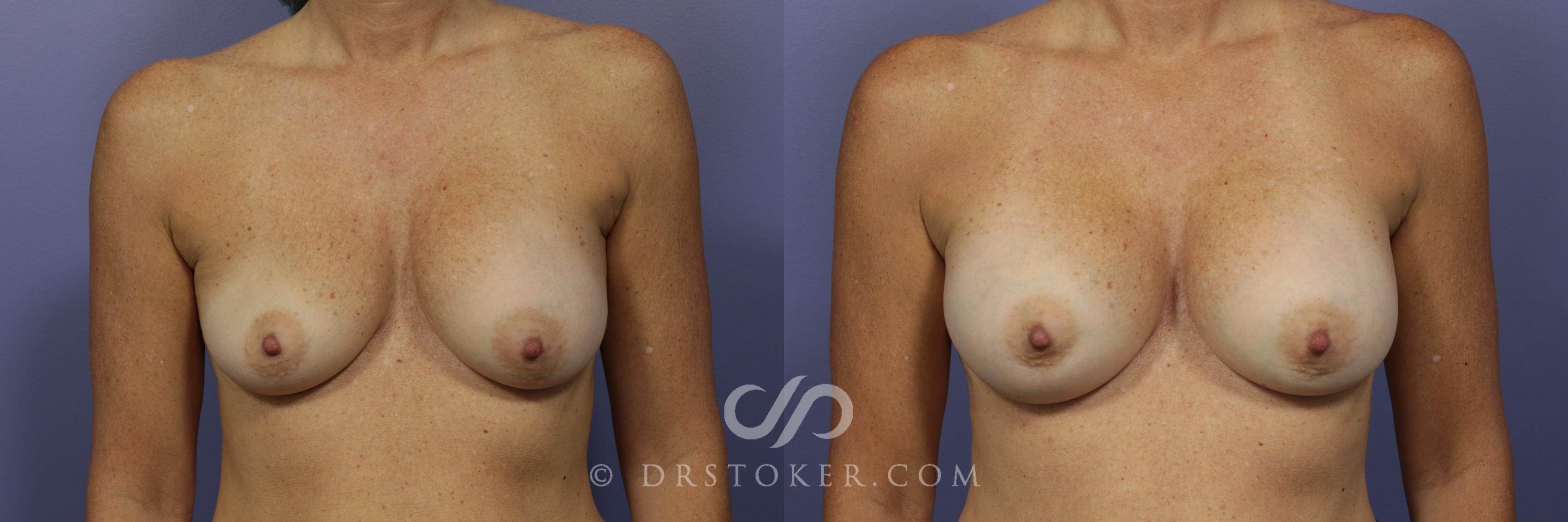 Before & After Breast Augmentation, Rapid Recovery Case 1029 View #1 View in Los Angeles, CA