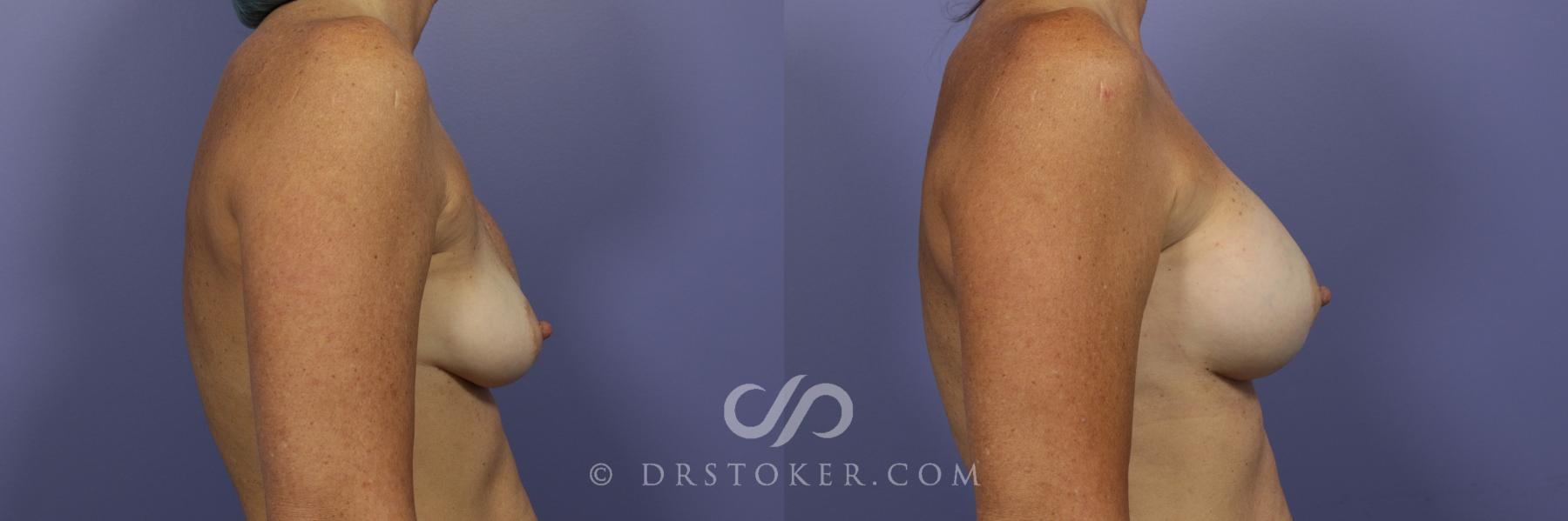 Before & After Breast Augmentation, Rapid Recovery Case 1029 View #2 View in Los Angeles, CA