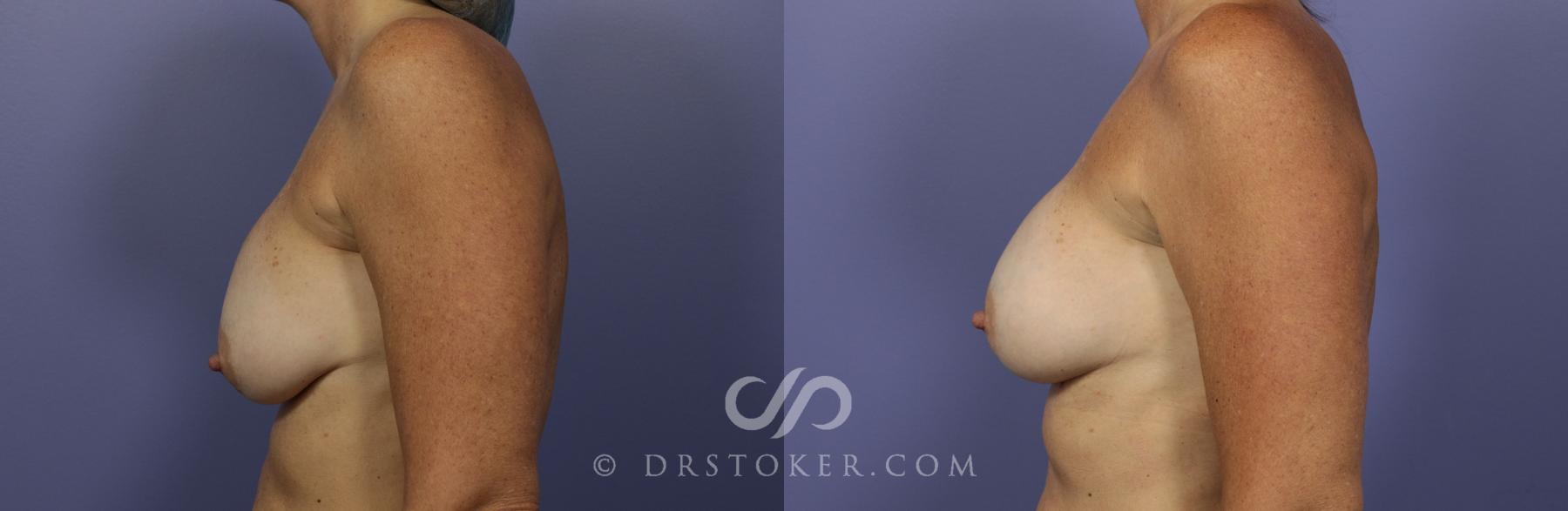 Before & After Breast Augmentation, Rapid Recovery Case 1029 View #3 View in Los Angeles, CA